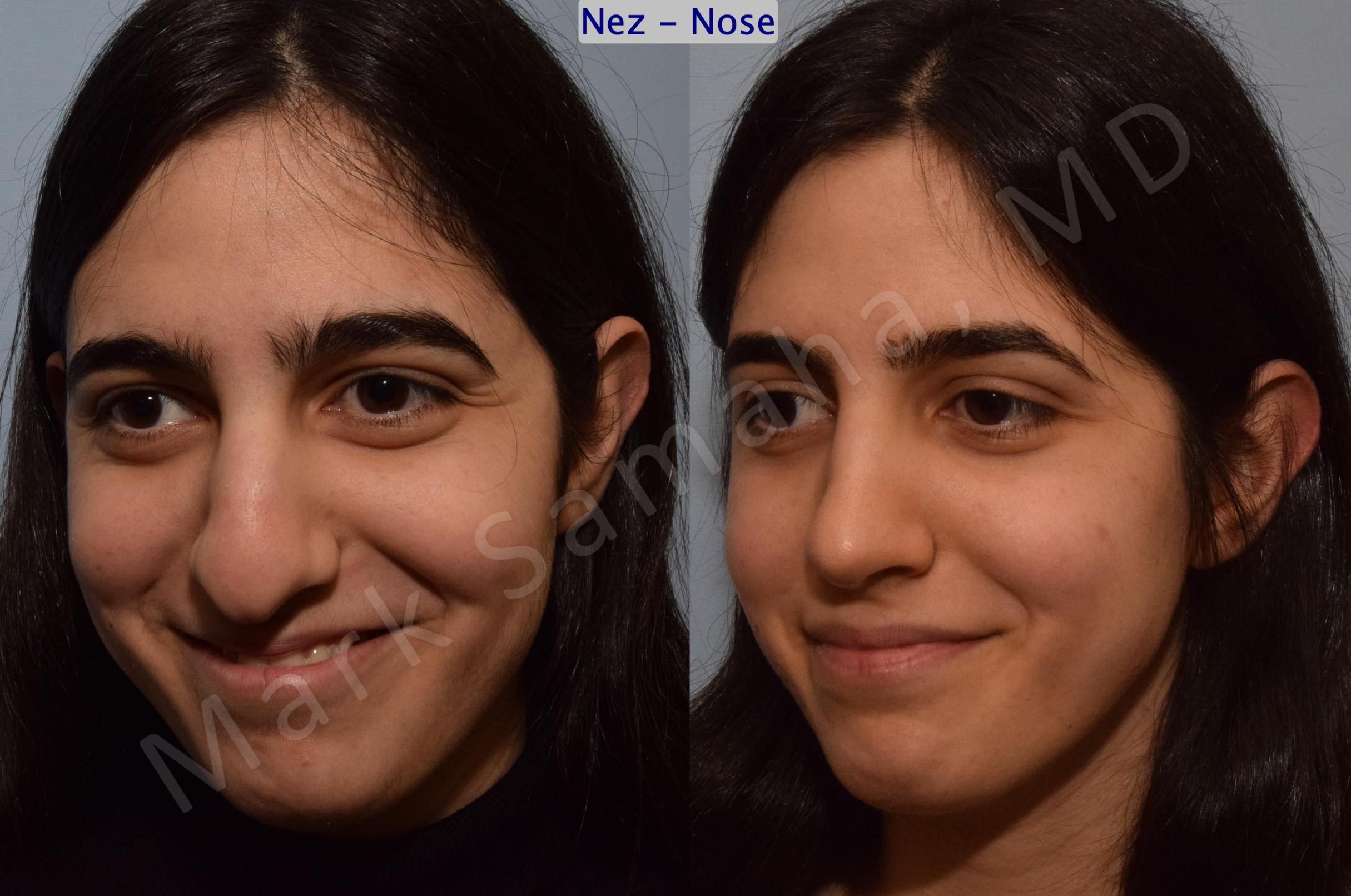 Before & After Rhinoplasty / Rhinoplastie Case 183 Left Oblique Smile  View in Mount Royal, QC