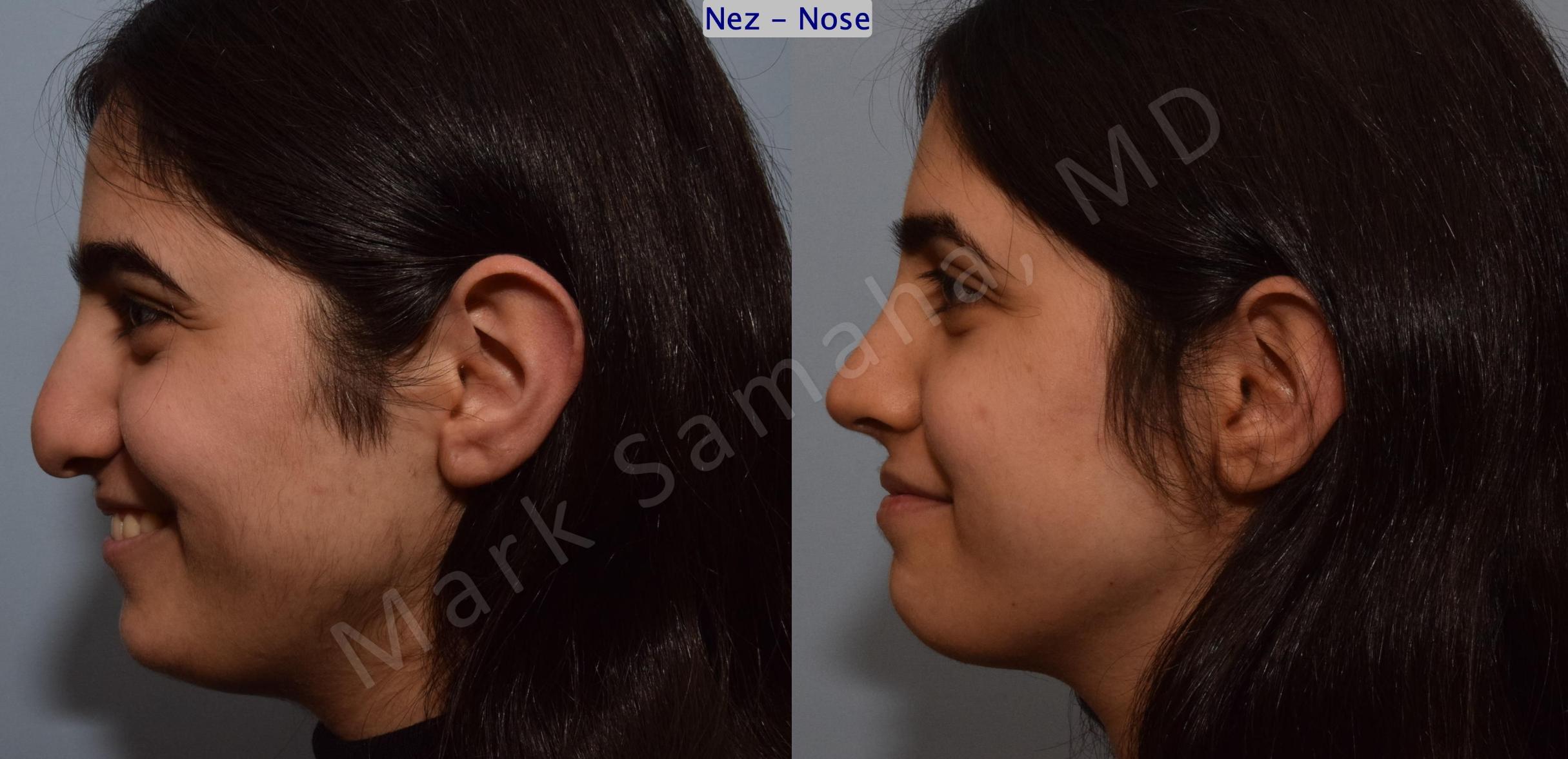 Before & After Rhinoplasty / Rhinoplastie Case 183 Left Side Smile View in Mount Royal, QC