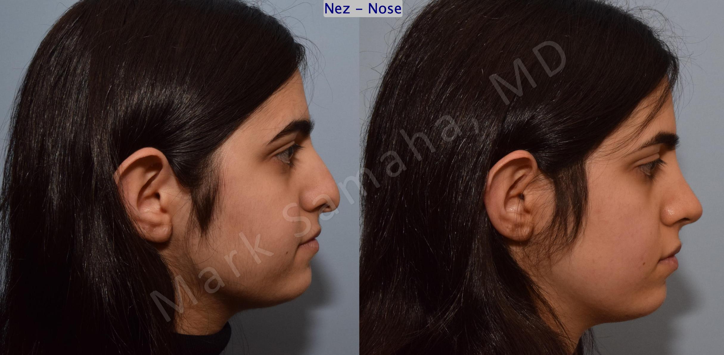 Before & After Rhinoplasty / Rhinoplastie Case 183 Right Side View in Mount Royal, QC