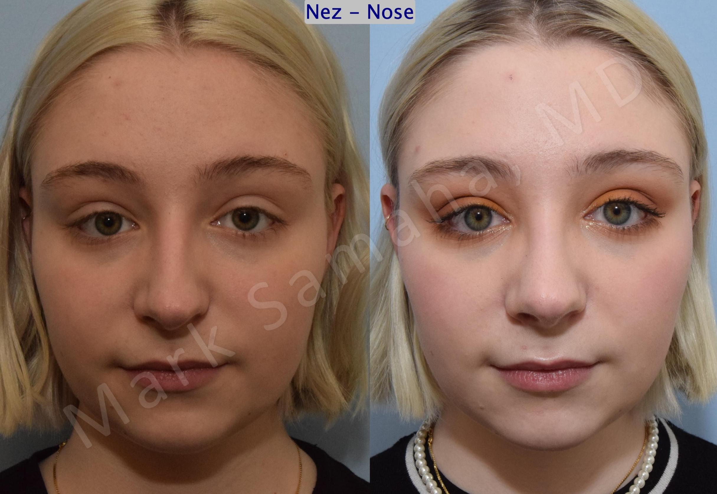 Before & After Rhinoplasty / Rhinoplastie Case 184 Front View in Mount Royal, QC
