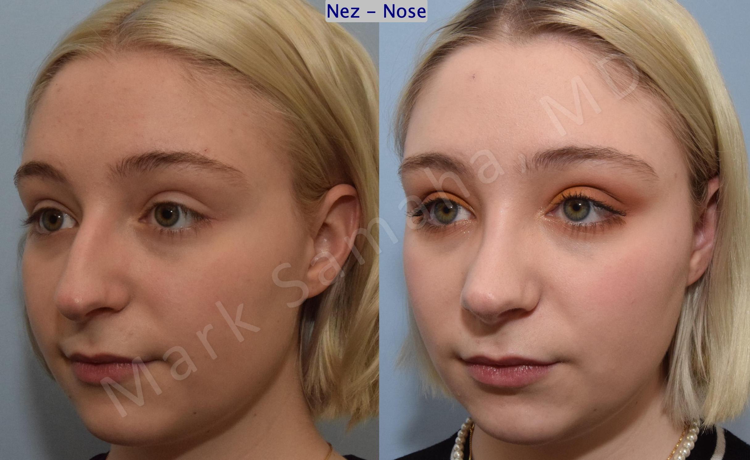 Before & After Rhinoplasty / Rhinoplastie Case 184 Left Oblique View in Mount Royal, QC