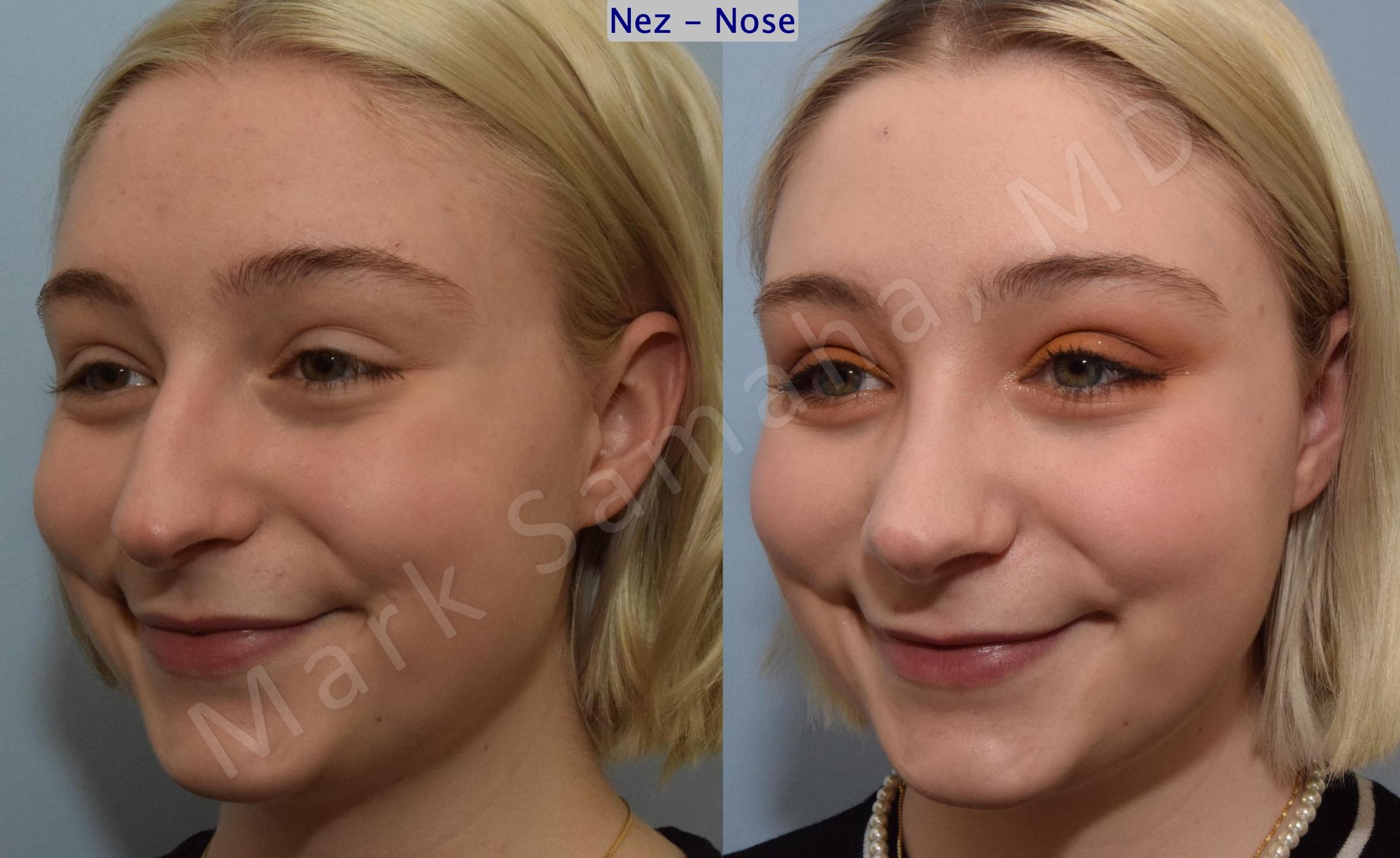 Before & After Rhinoplasty / Rhinoplastie Case 184 Left Oblique Smile View in Mount Royal, QC