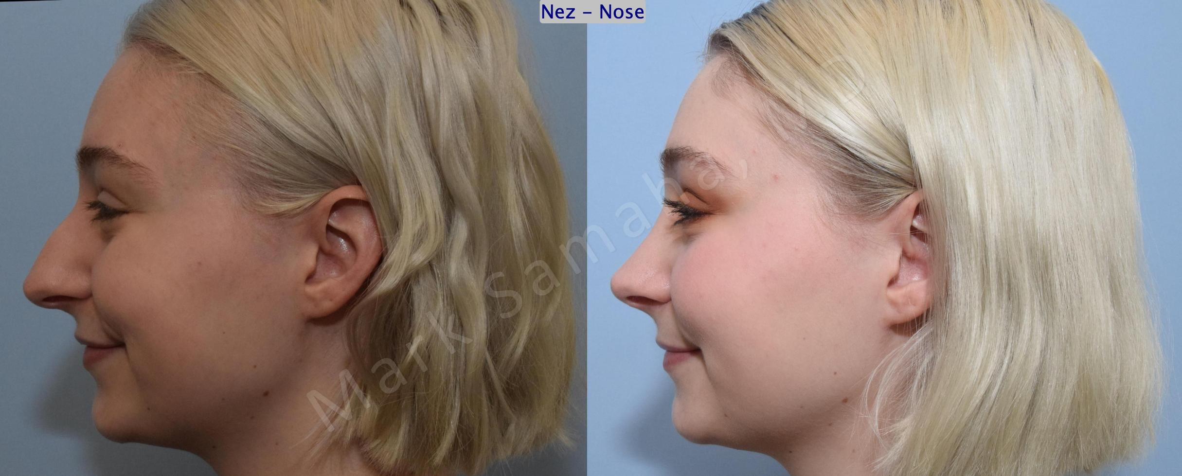 Before & After Rhinoplasty / Rhinoplastie Case 184 Left Profile Smile  View in Mount Royal, QC
