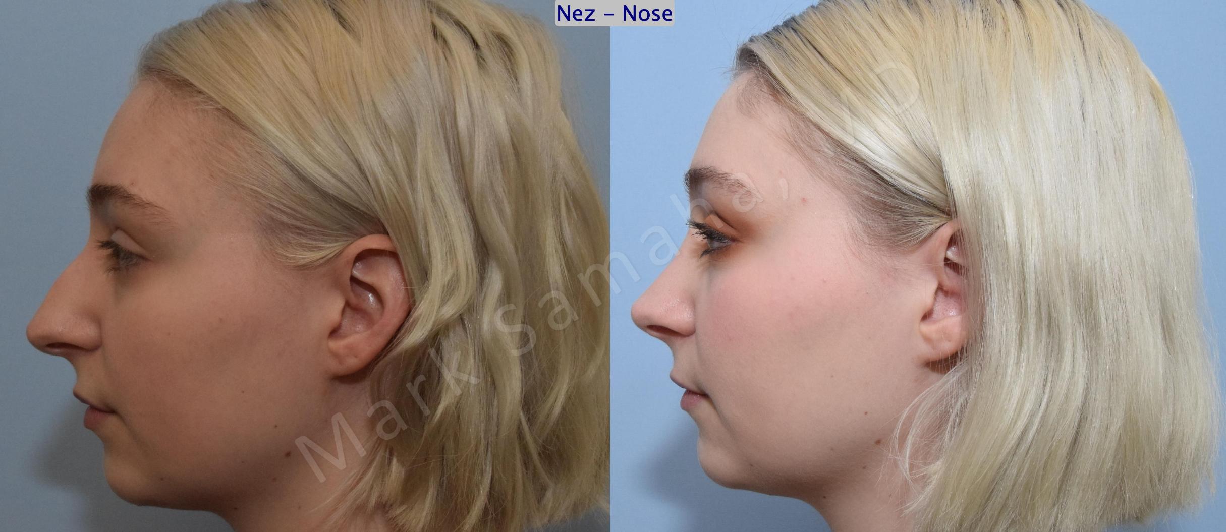 Before & After Rhinoplasty / Rhinoplastie Case 184 Left Side View in Mount Royal, QC