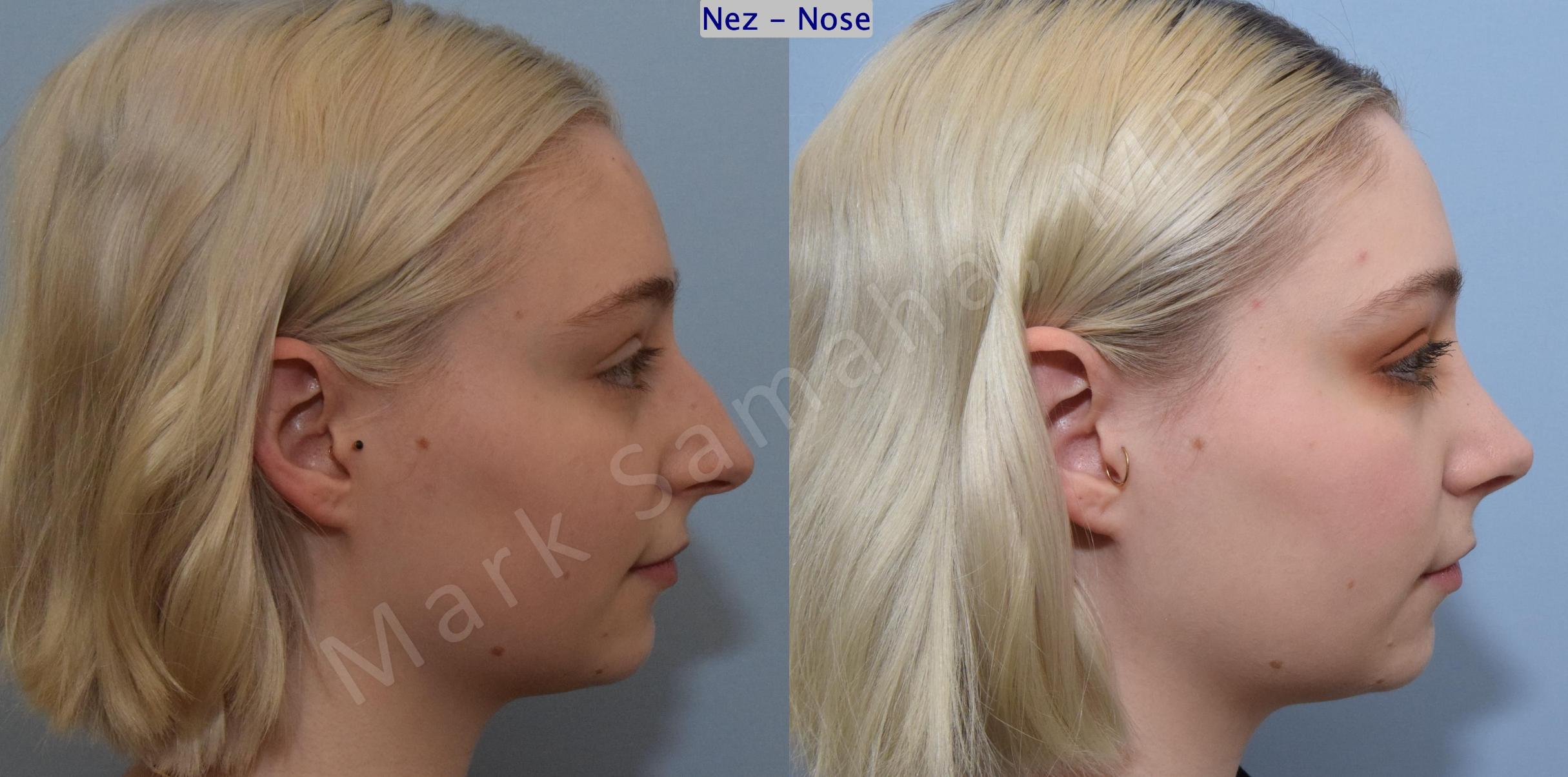 Before & After Rhinoplasty / Rhinoplastie Case 184 Right Side View in Mount Royal, QC