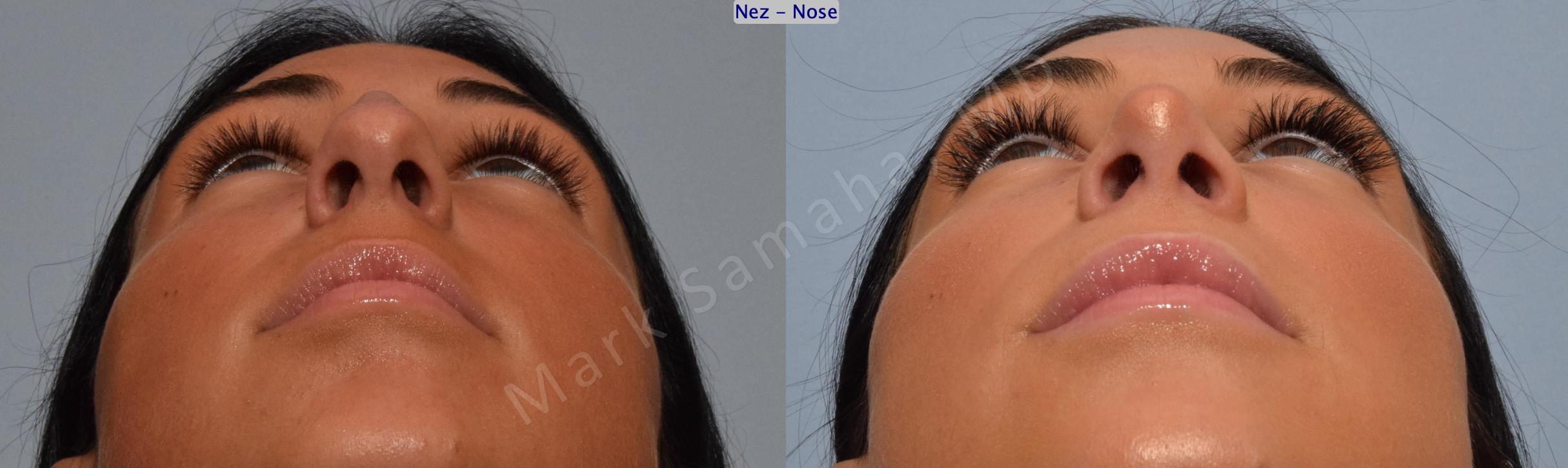 Before & After Rhinoplasty / Rhinoplastie Case 185 Basal View in Mount Royal, QC