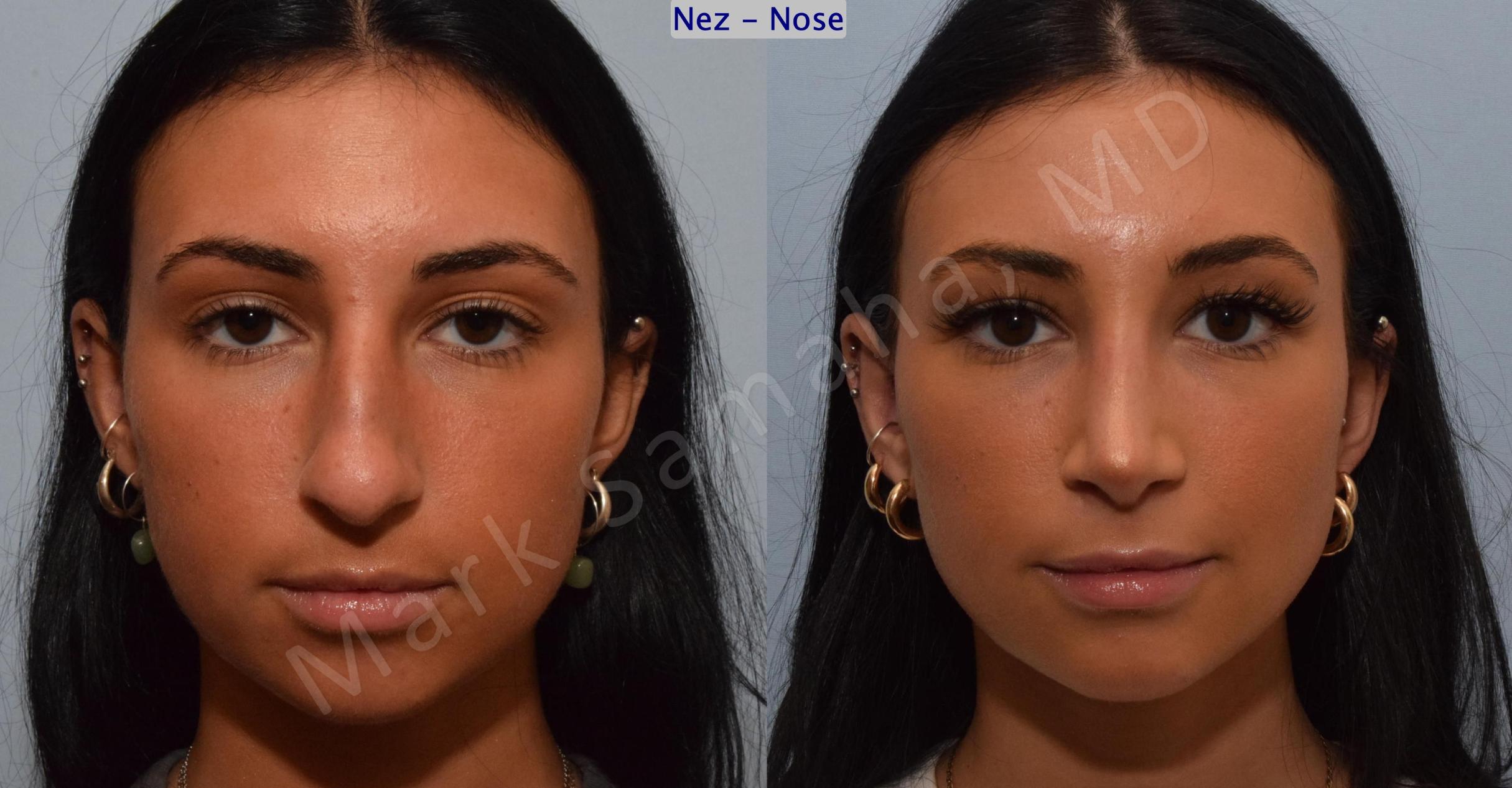 Before & After Rhinoplasty / Rhinoplastie Case 185 Front View in Mount Royal, QC