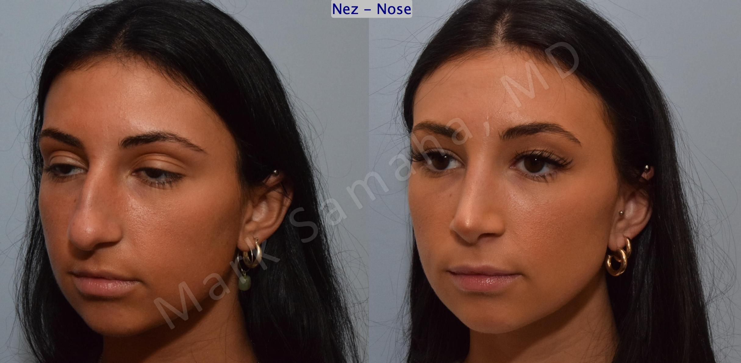 Before & After Rhinoplasty / Rhinoplastie Case 185 Left Oblique View in Mount Royal, QC