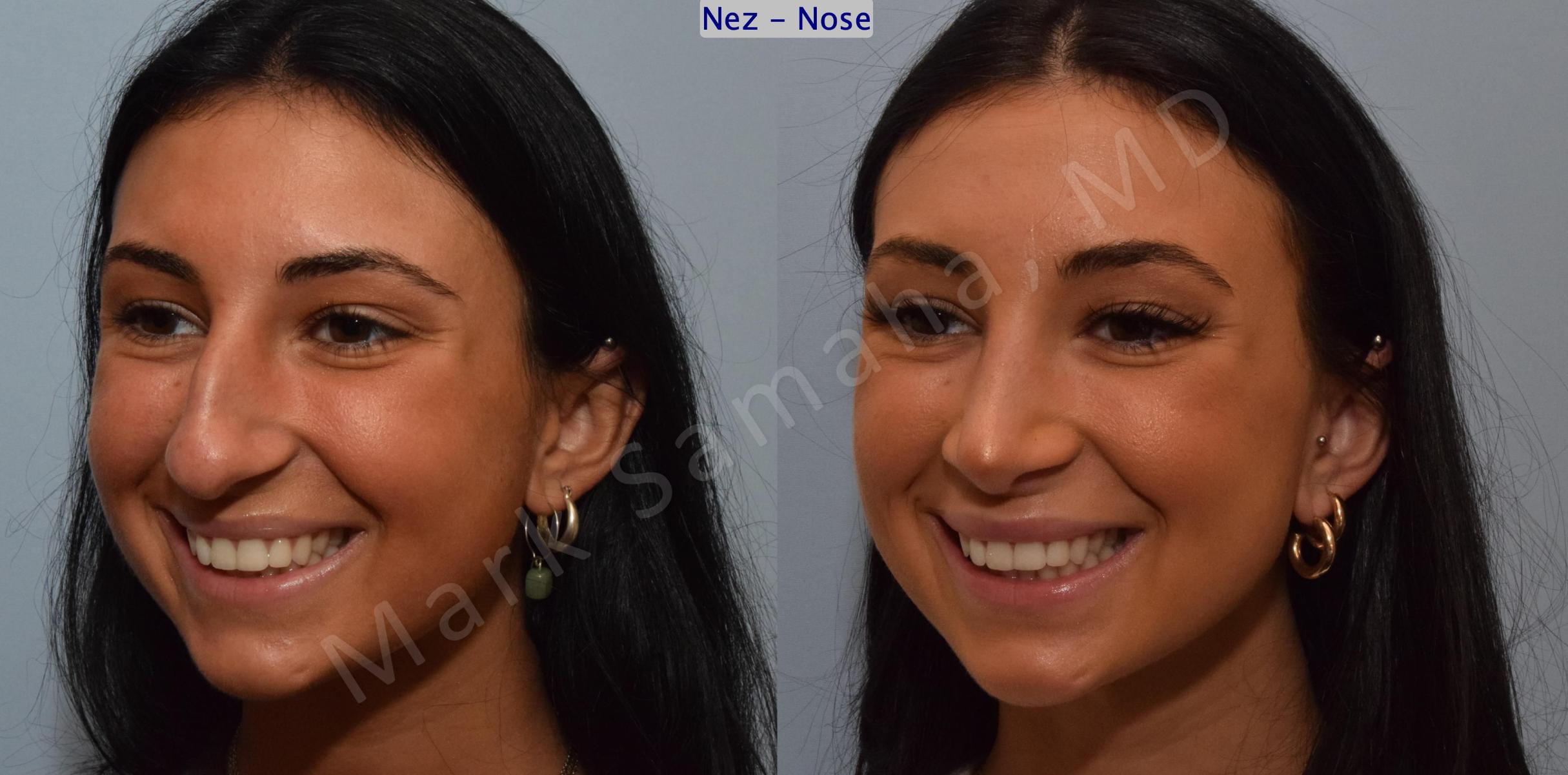 Before & After Rhinoplasty / Rhinoplastie Case 185 Left Oblique Smile View in Mount Royal, QC