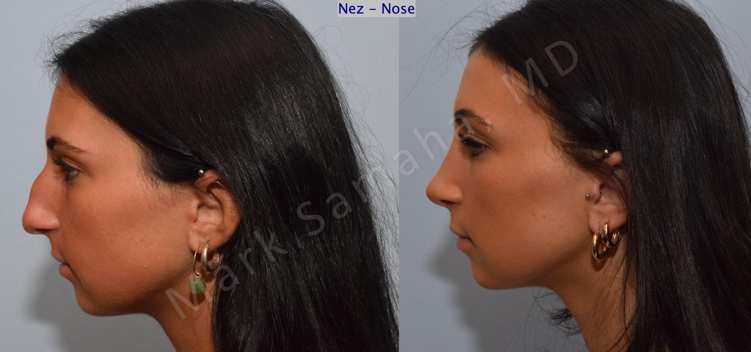 Before & After Rhinoplasty / Rhinoplastie Case 185 Left Side View in Mount Royal, QC