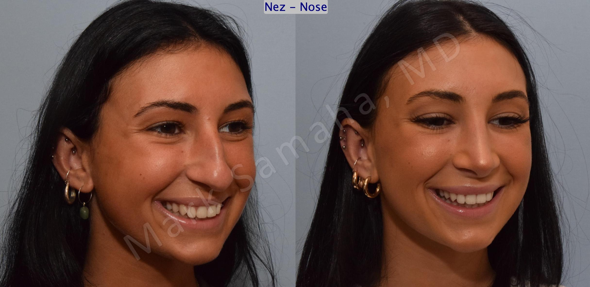 Before & After Rhinoplasty / Rhinoplastie Case 185 Right Oblique Smile View in Mount Royal, QC