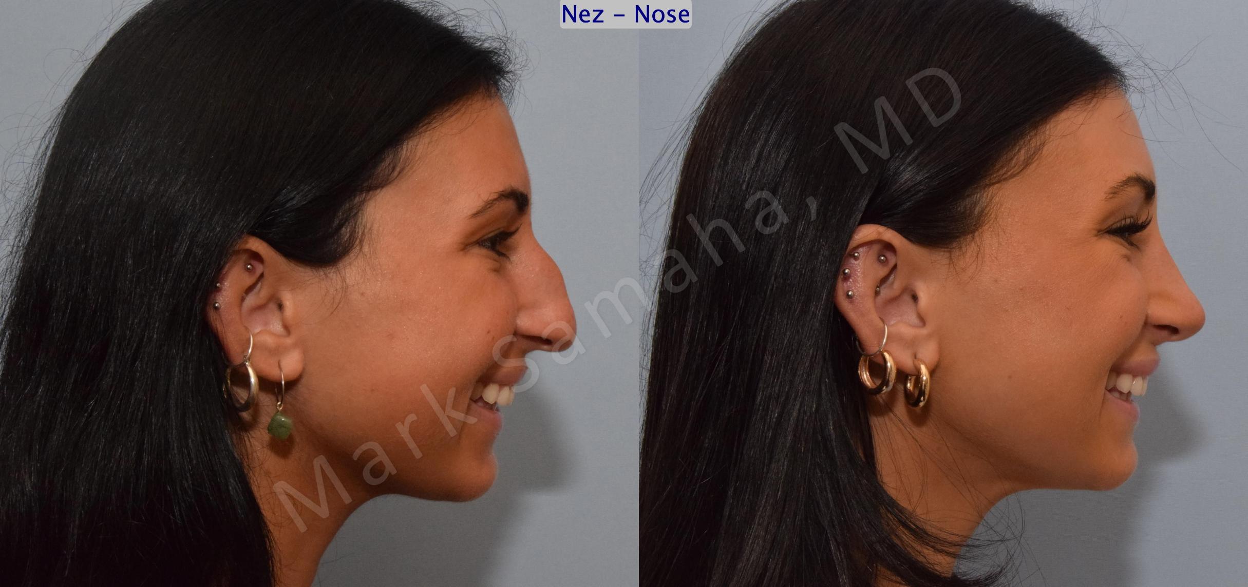 Before & After Rhinoplasty / Rhinoplastie Case 185 Right Side Smile View in Mount Royal, QC