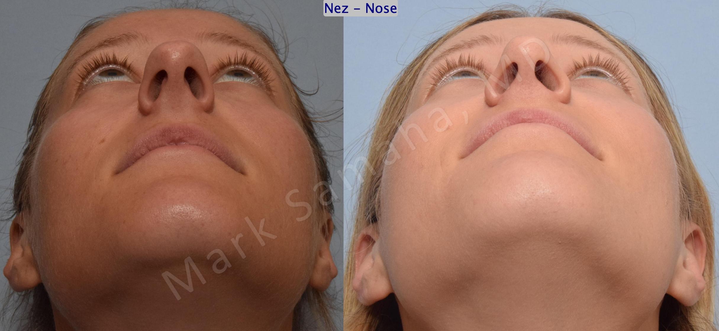 Before & After Rhinoplastie / Rhinoplasty Case 186 Basal View in Mount Royal, QC