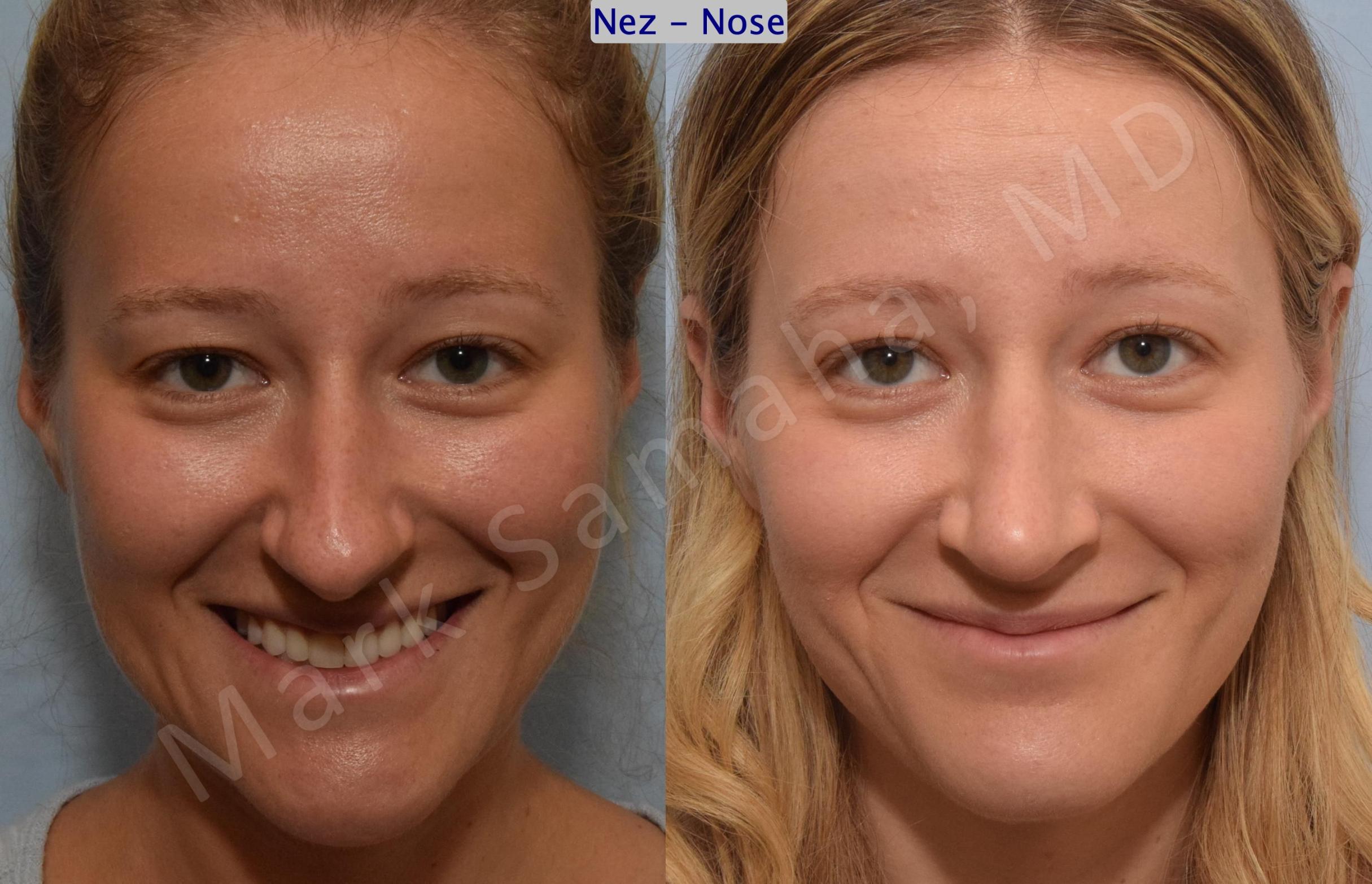 Before & After Rhinoplastie / Rhinoplasty Case 186 Front Smile View in Mount Royal, QC