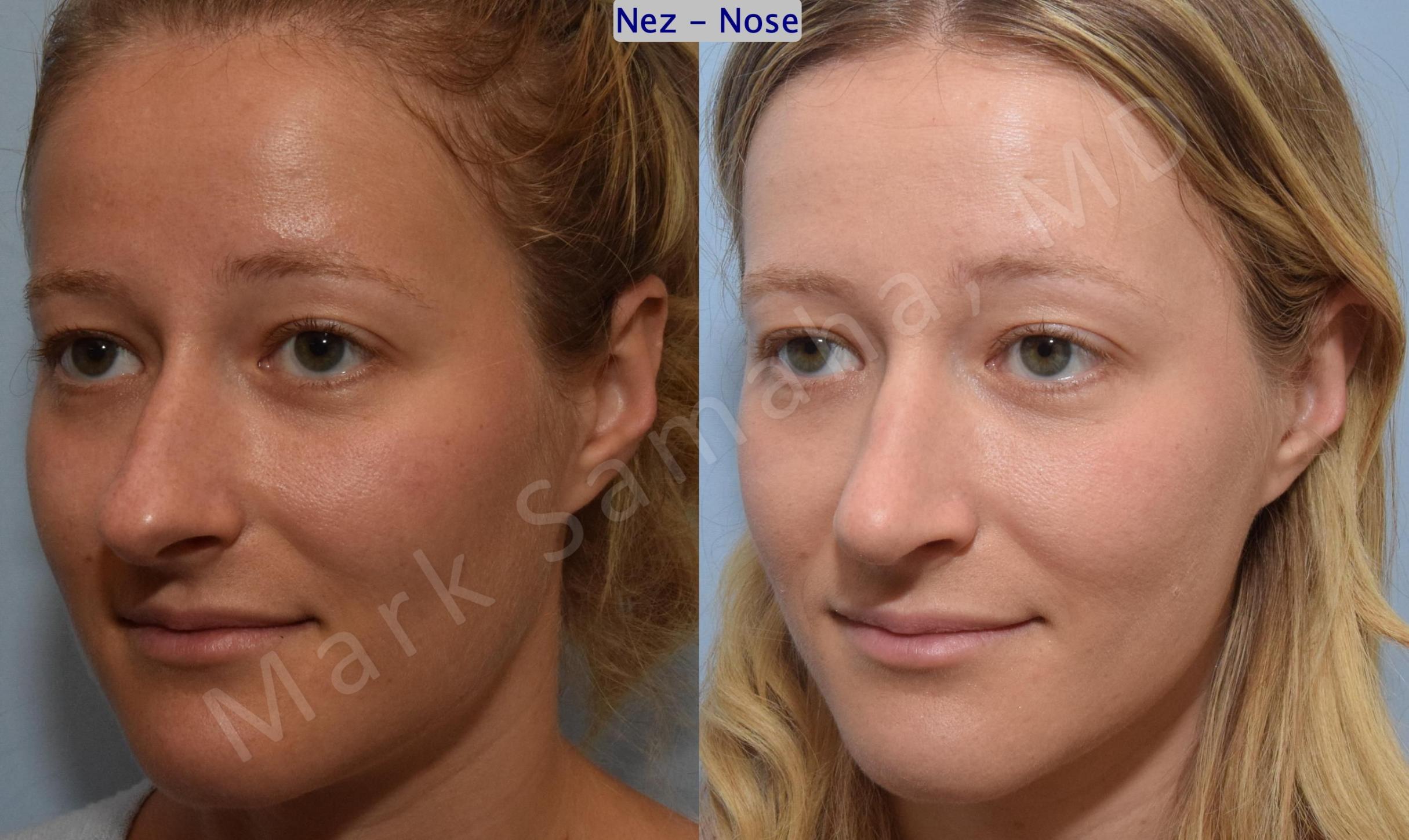 Before & After Rhinoplastie / Rhinoplasty Case 186 Left Oblique View in Mount Royal, QC