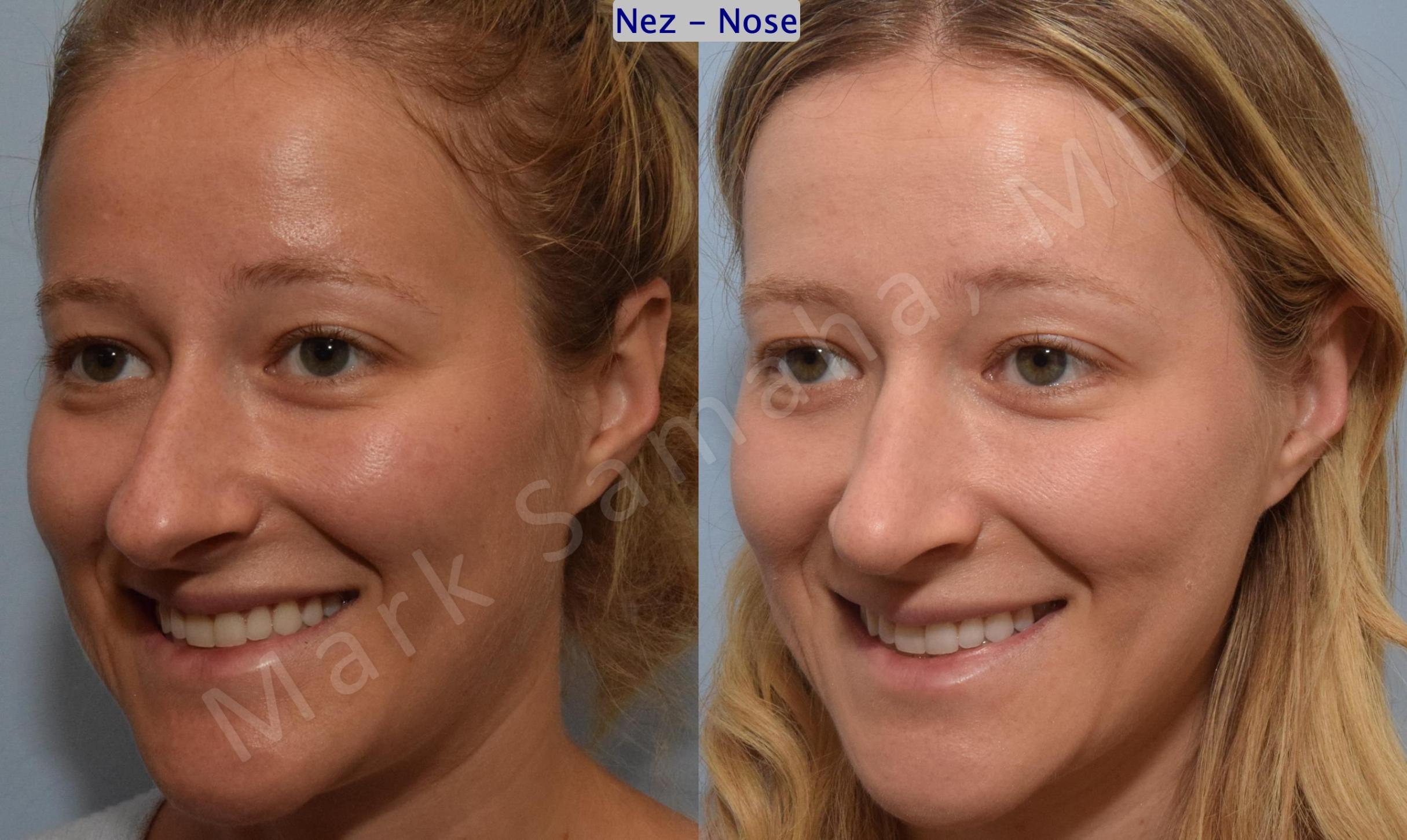 Before & After Rhinoplasty / Rhinoplastie Case 186 Left Oblique Smile View in Mount Royal, QC