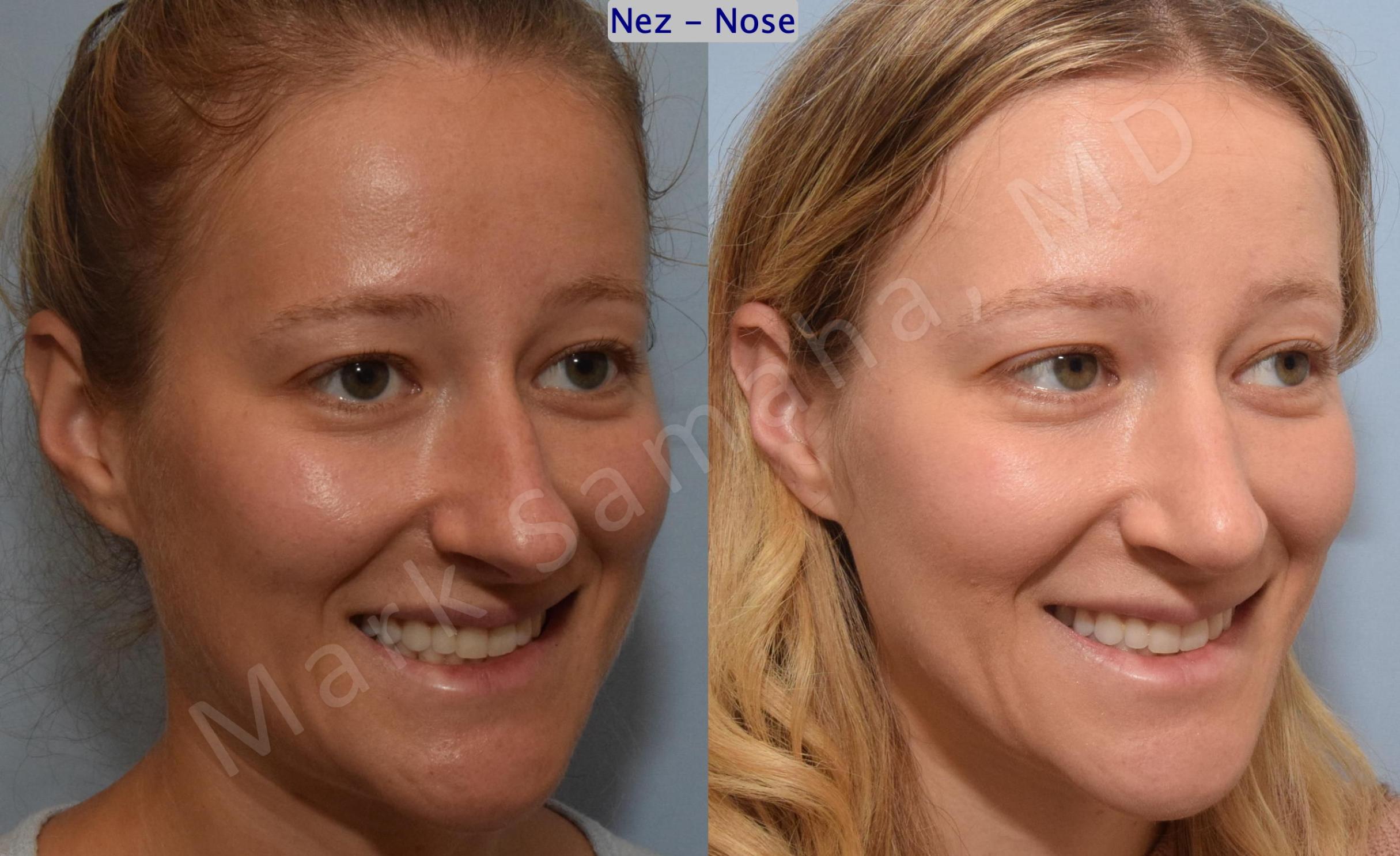 Before & After Rhinoplastie / Rhinoplasty Case 186 Right Oblique Smile View in Mount Royal, QC