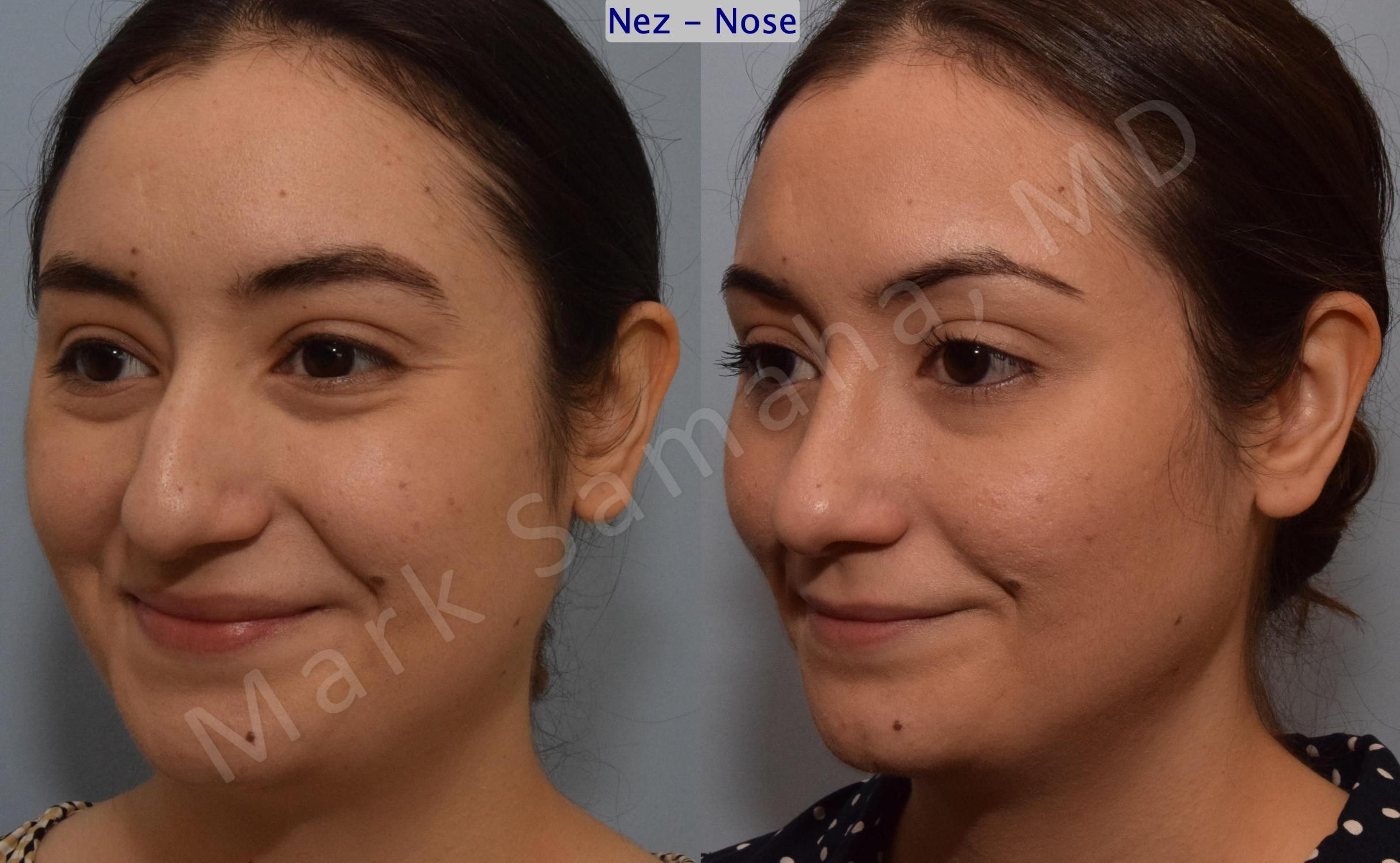Before & After Rhinoplasty / Rhinoplastie Case 187 Left Oblique Smile View in Mount Royal, QC