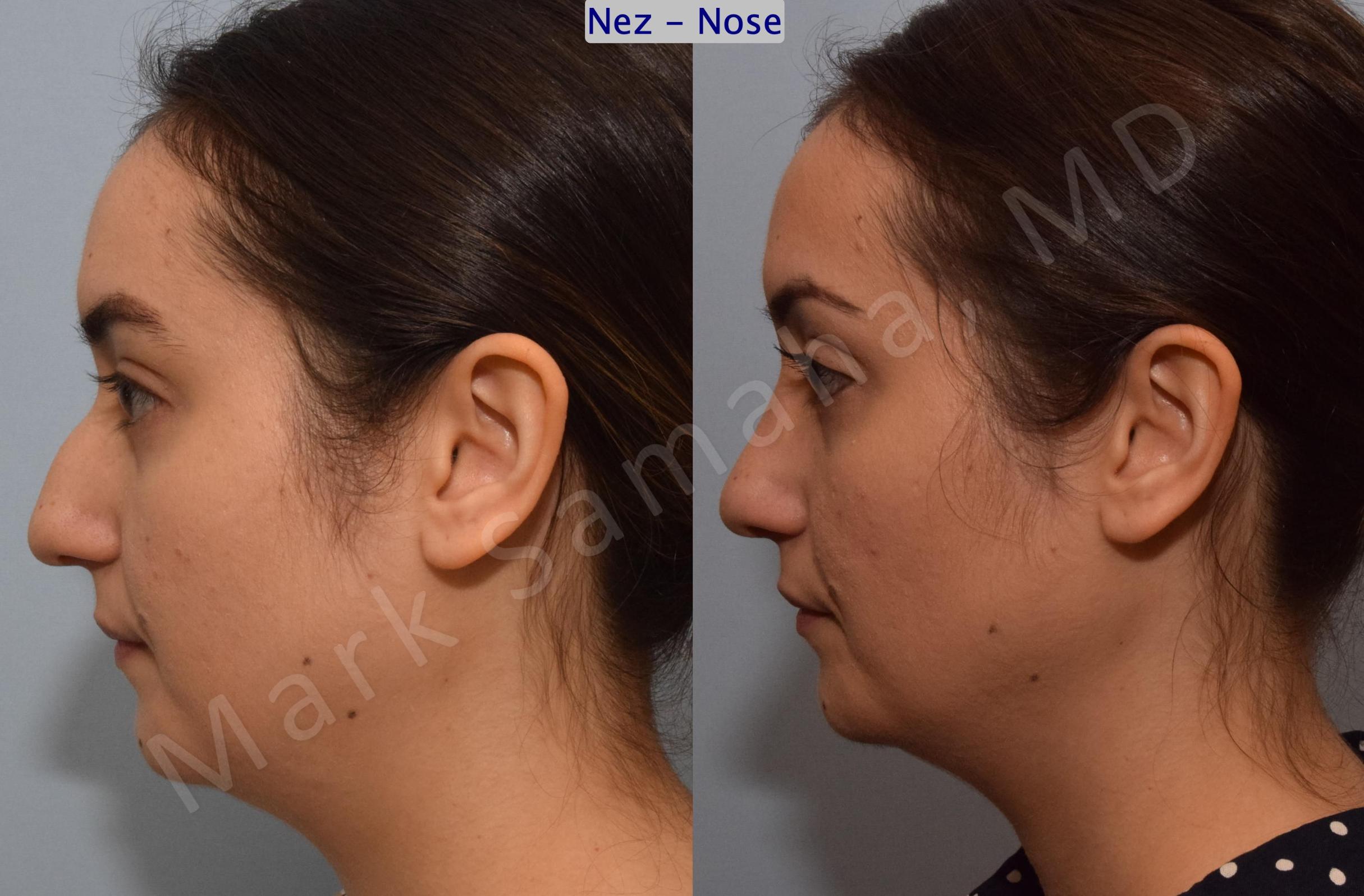 Before & After Rhinoplasty / Rhinoplastie Case 187 Left Side View in Mount Royal, QC