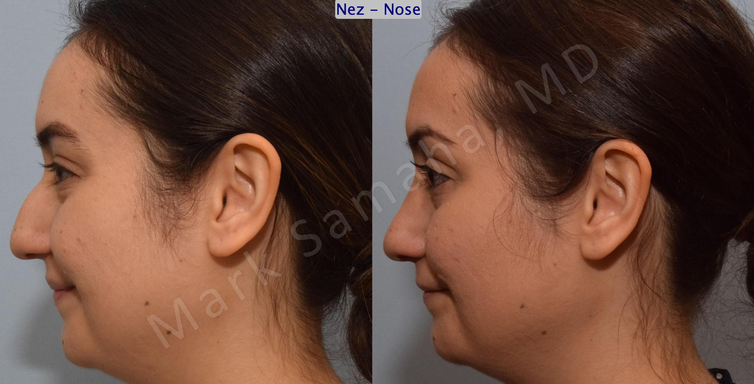 Before & After Rhinoplasty / Rhinoplastie Case 187 Left Side Smile View in Mount Royal, QC