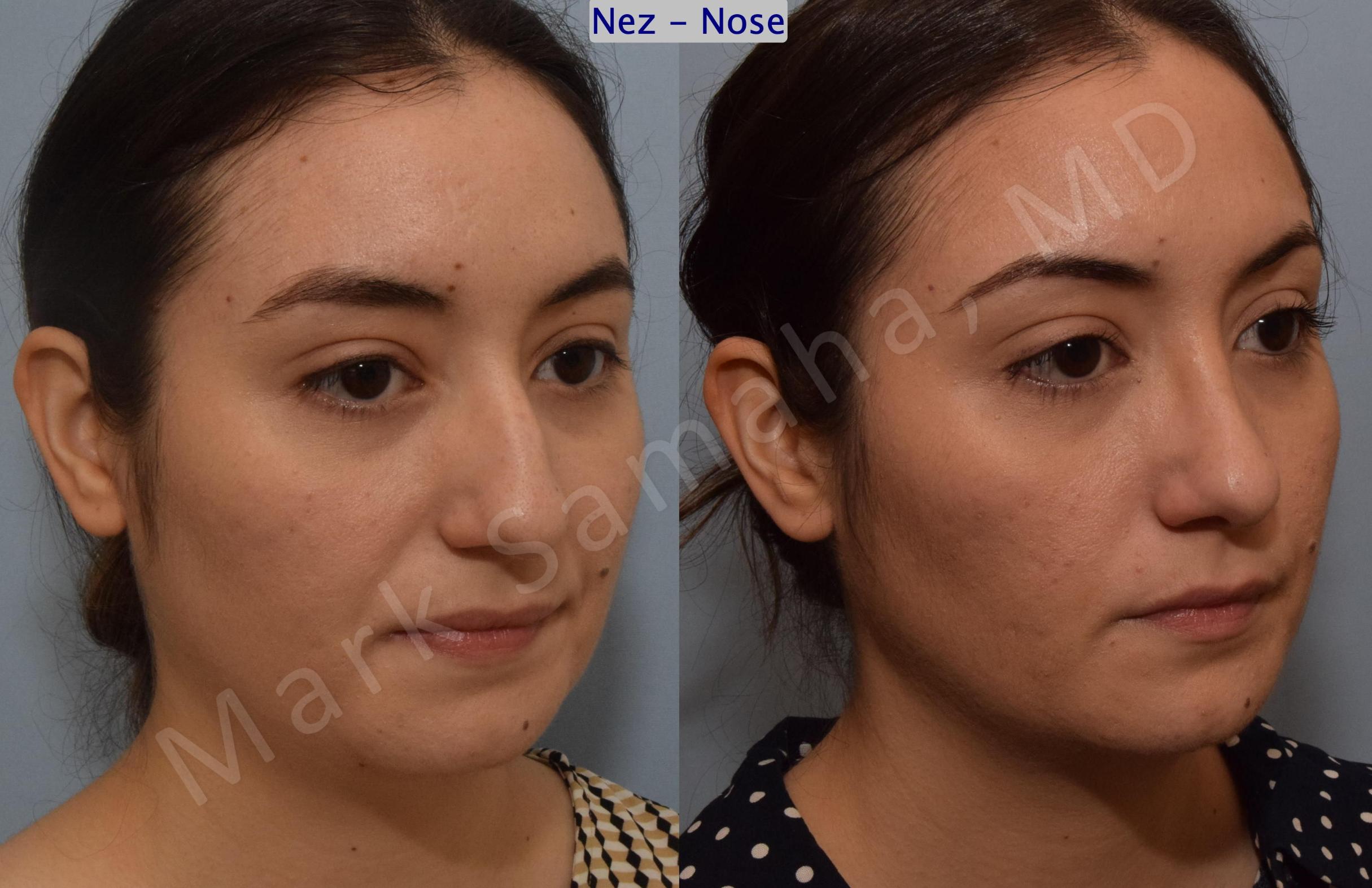 Before & After Rhinoplasty / Rhinoplastie Case 187 Right Oblique View in Mount Royal, QC
