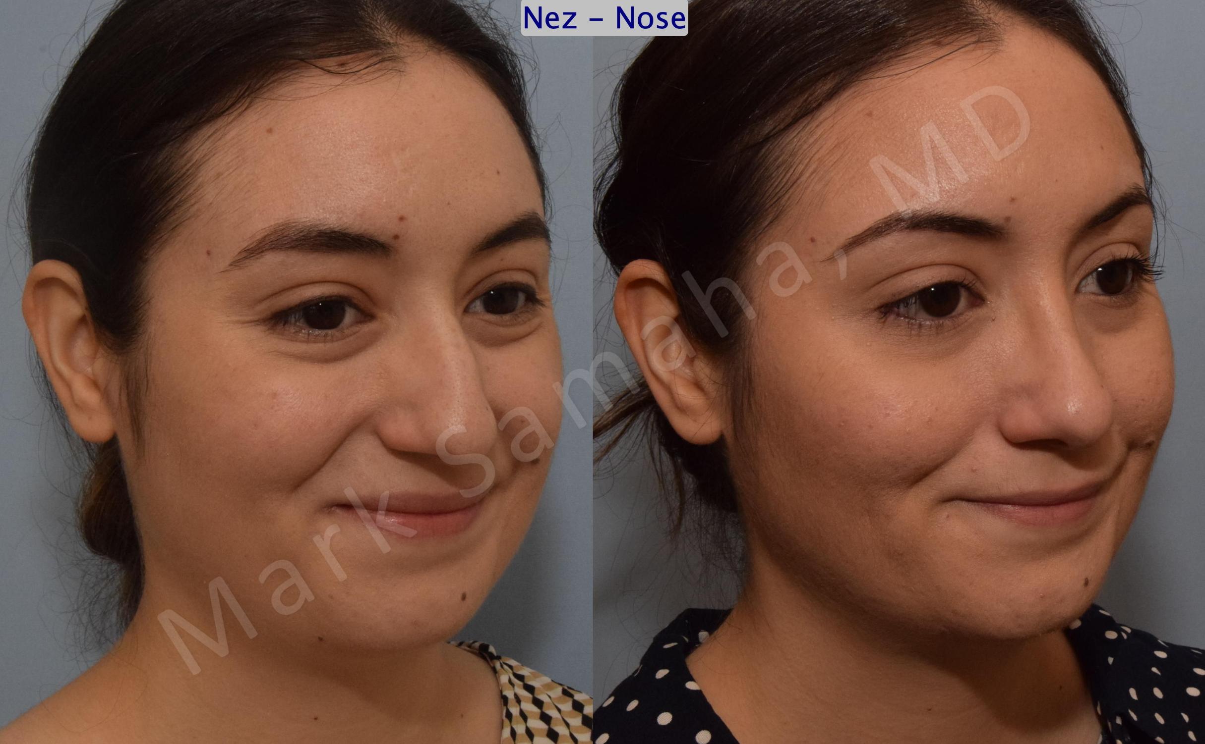 Before & After Rhinoplasty / Rhinoplastie Case 187 Right Oblique Smile View in Mount Royal, QC