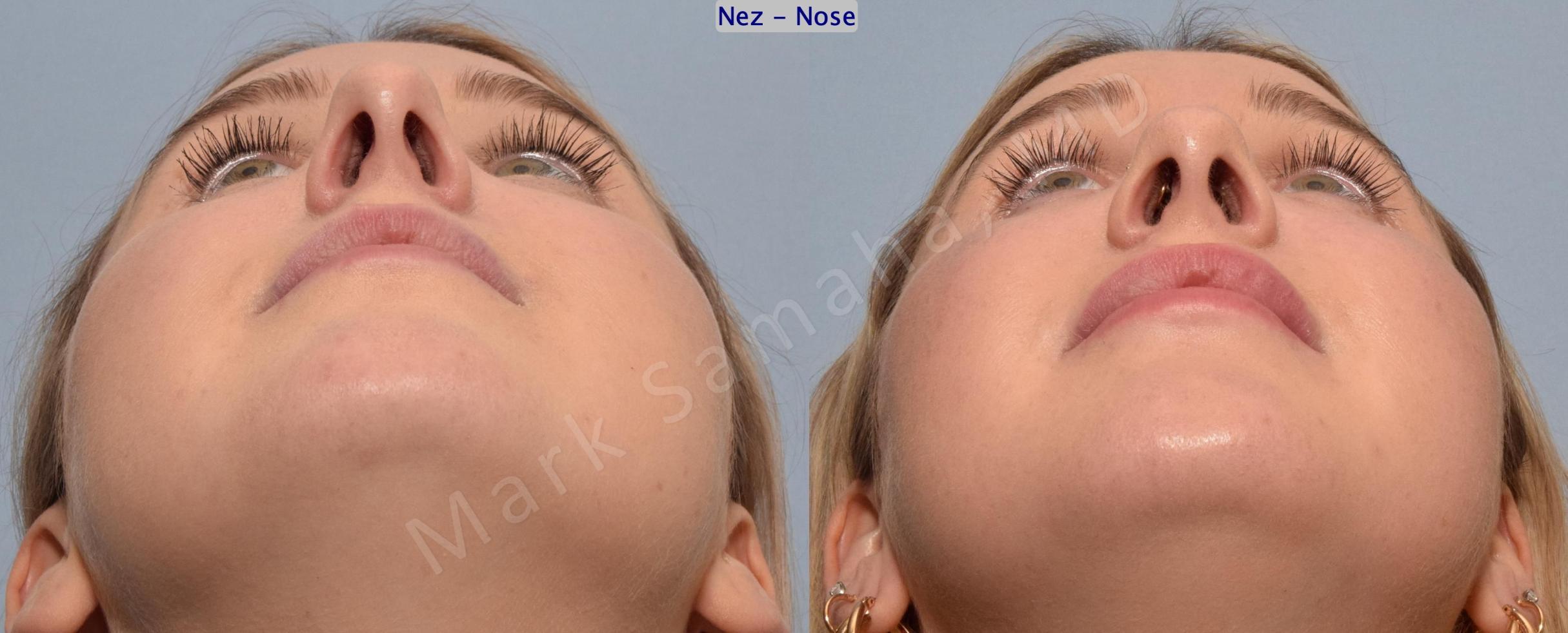 Before & After Rhinoplasty / Rhinoplastie Case 188 Basal View in Mount Royal, QC