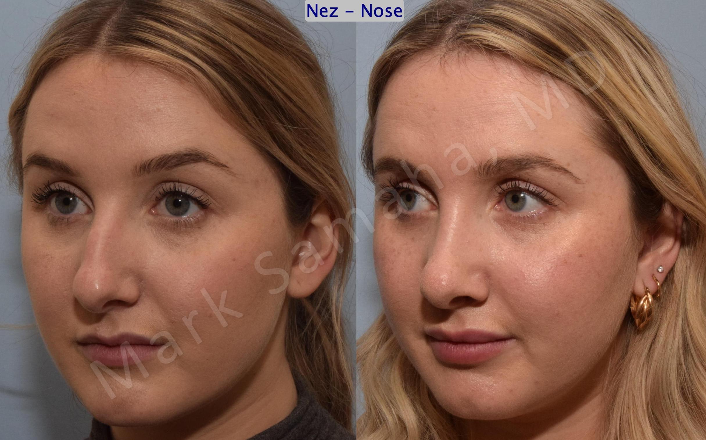 Before & After Rhinoplasty / Rhinoplastie Case 188 Left Oblique View in Mount Royal, QC