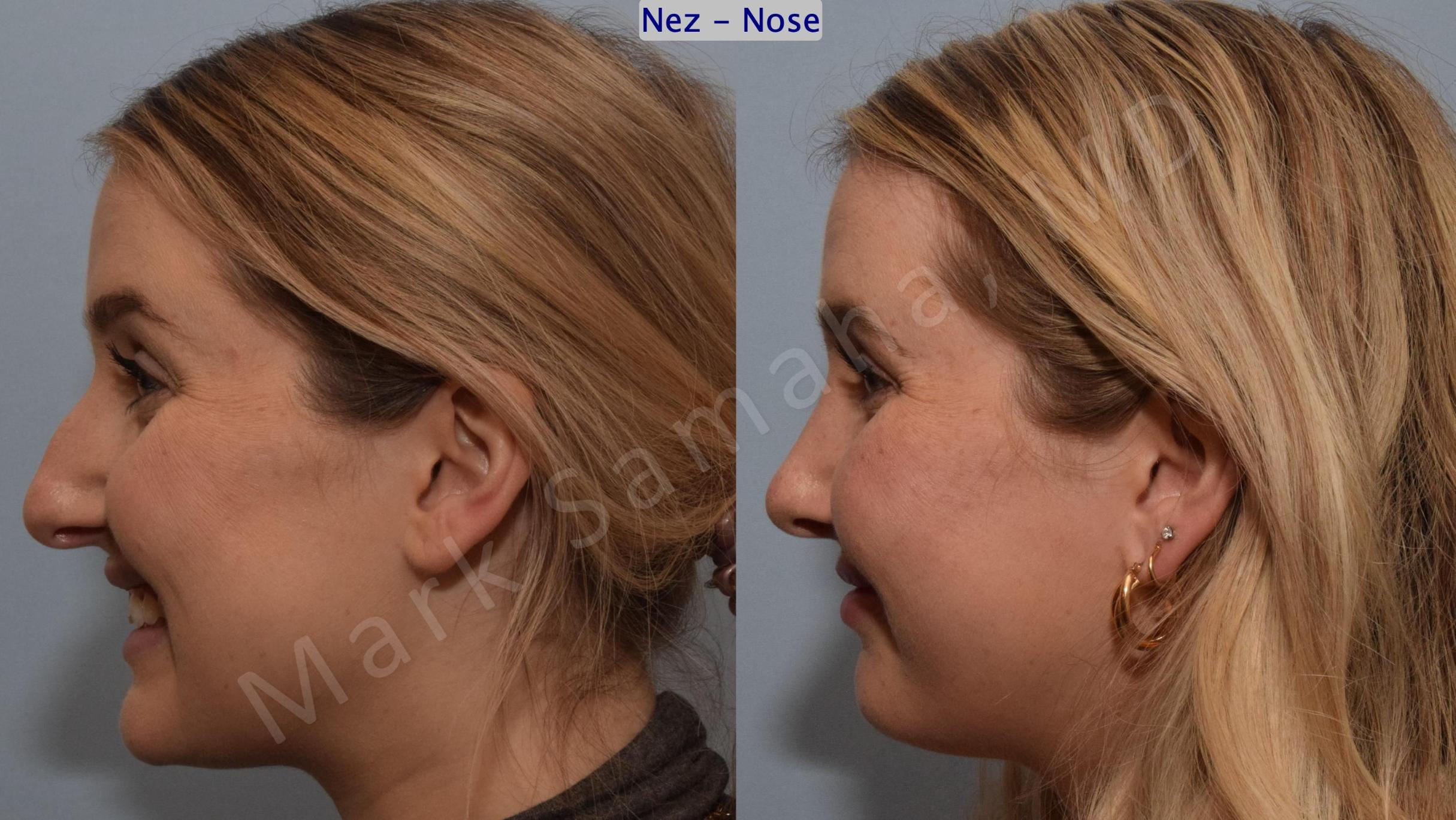 Before & After Rhinoplastie / Rhinoplasty Case 188 Left Side Smile View in Mount Royal, QC