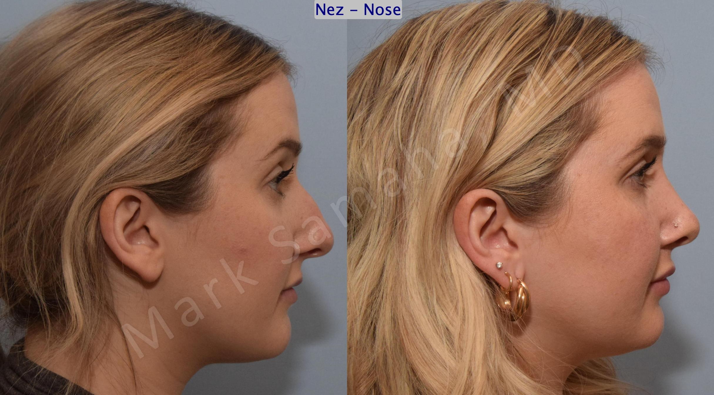 Before & After Rhinoplastie / Rhinoplasty Case 188 Right Side View in Mount Royal, QC