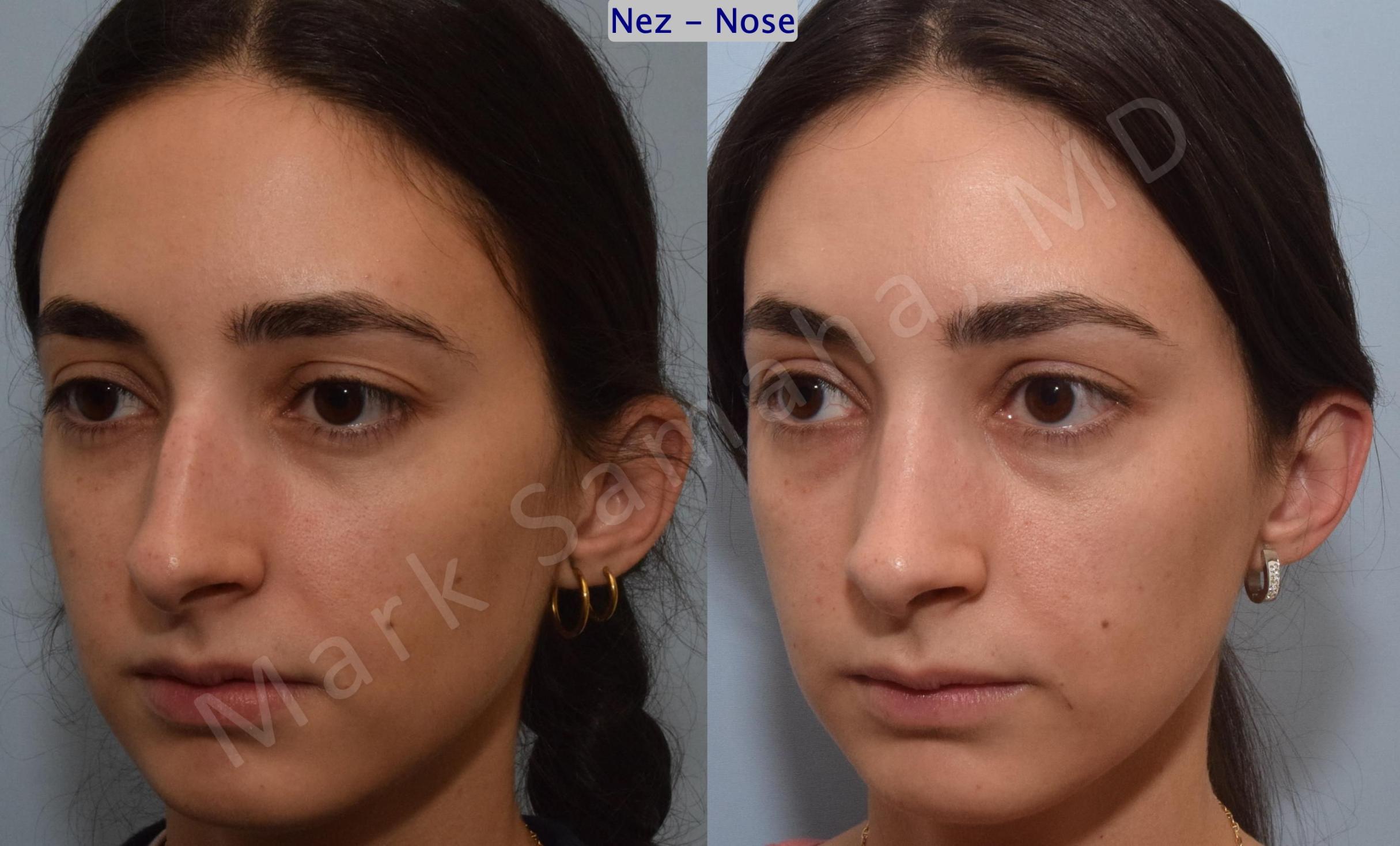 Before & After Rhinoplasty / Rhinoplastie Case 189 Left Oblique View in Mount Royal, QC