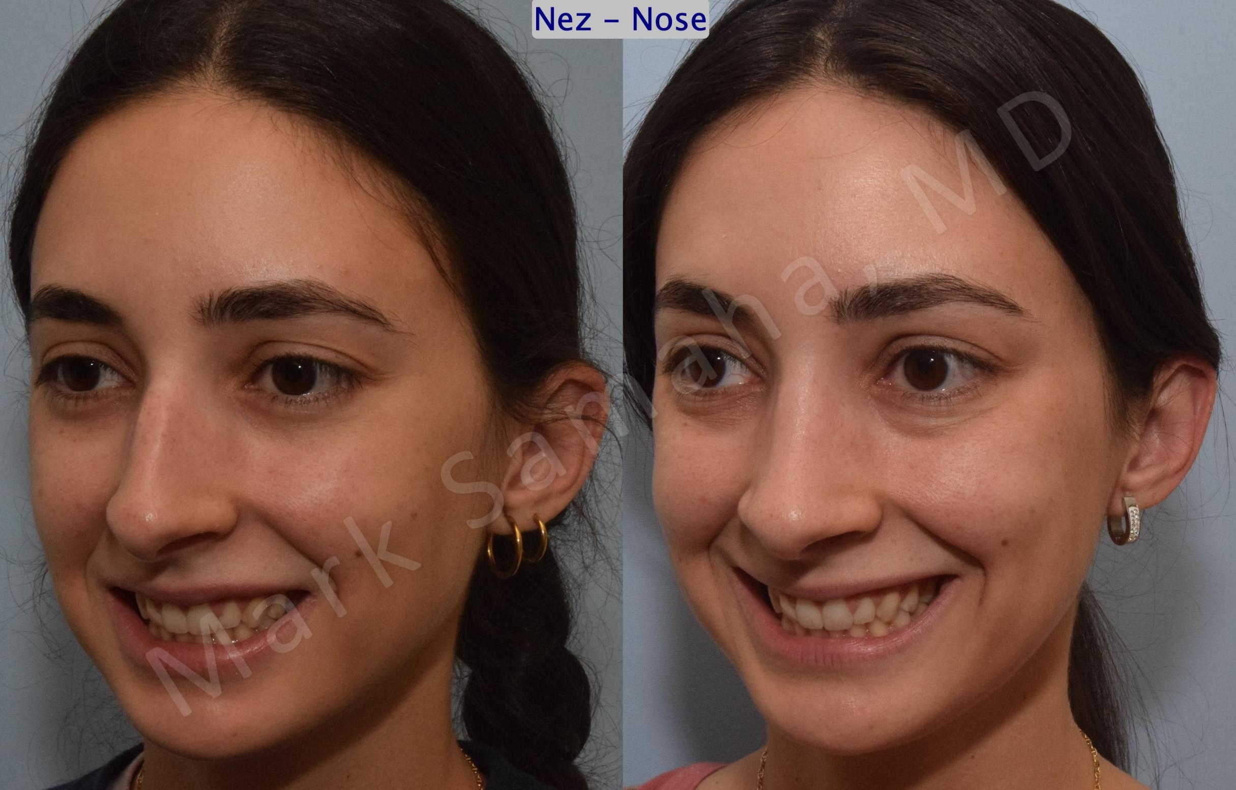 Before & After Rhinoplasty / Rhinoplastie Case 189 Left Oblique Smile  View in Mount Royal, QC