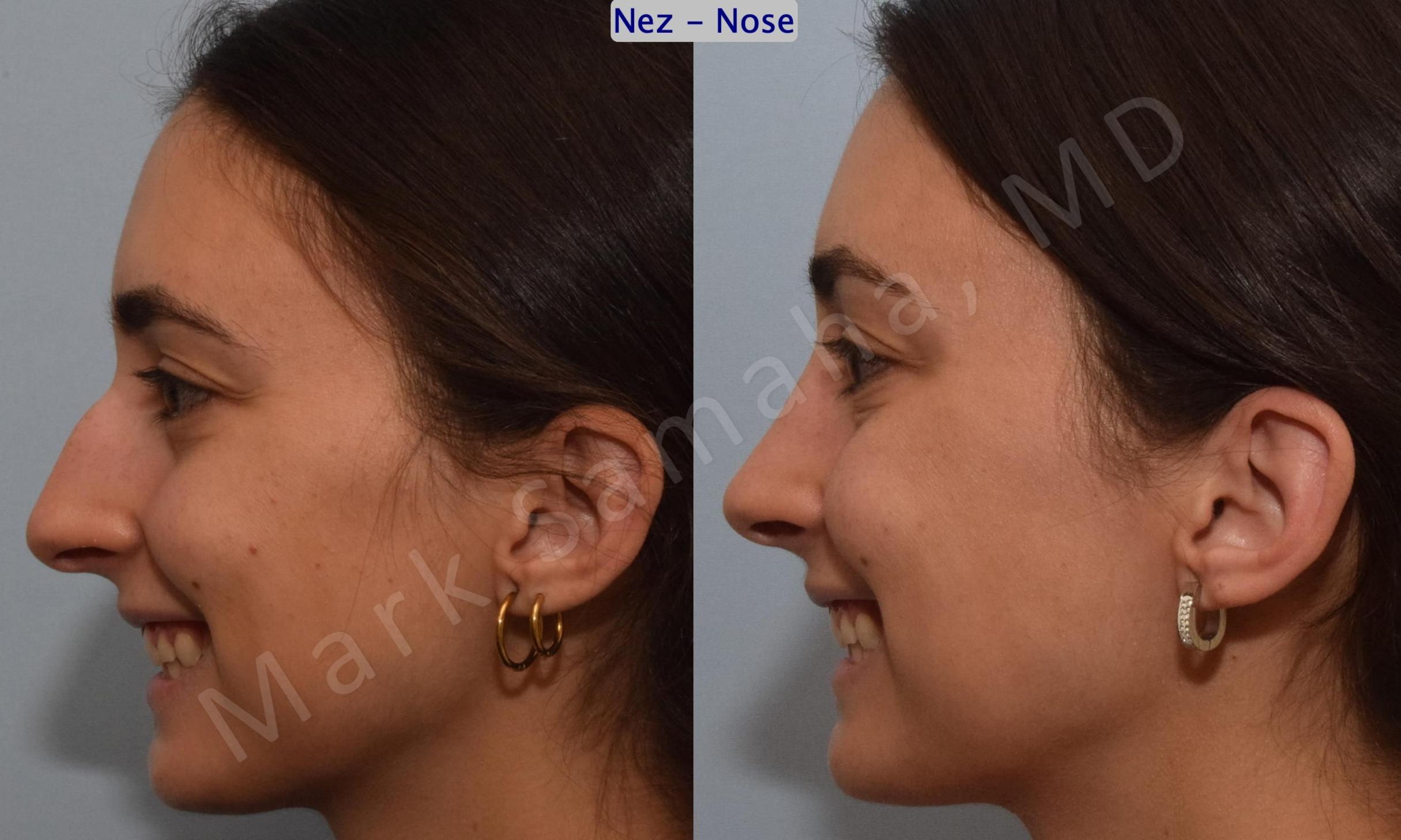 Before & After Rhinoplasty / Rhinoplastie Case 189 Left Side Smile View in Mount Royal, QC
