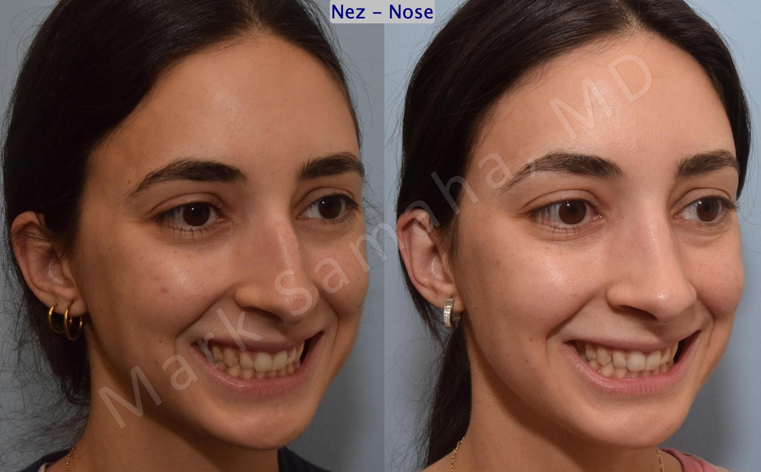 Before & After Rhinoplasty / Rhinoplastie Case 189 Right Oblique Smile View in Mount Royal, QC