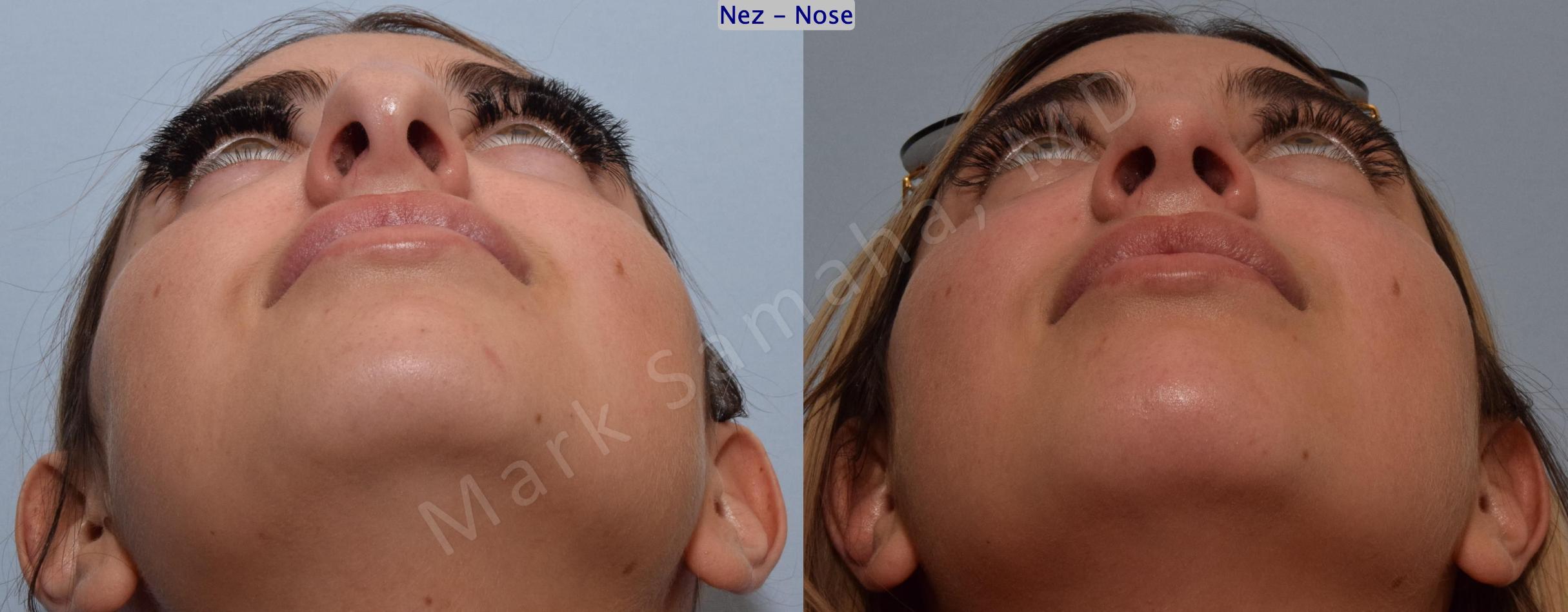 Before & After Rhinoplasty / Rhinoplastie Case 190 Basal View in Mount Royal, QC