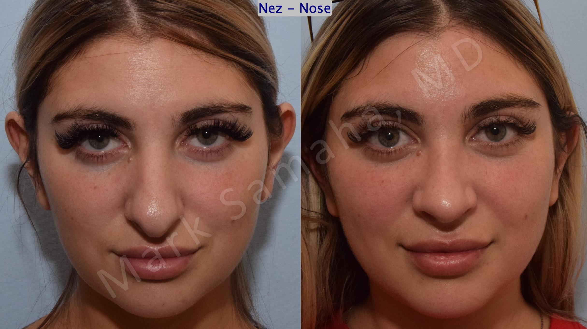 Before & After Rhinoplastie / Rhinoplasty Case 190 Front View in Mount Royal, QC