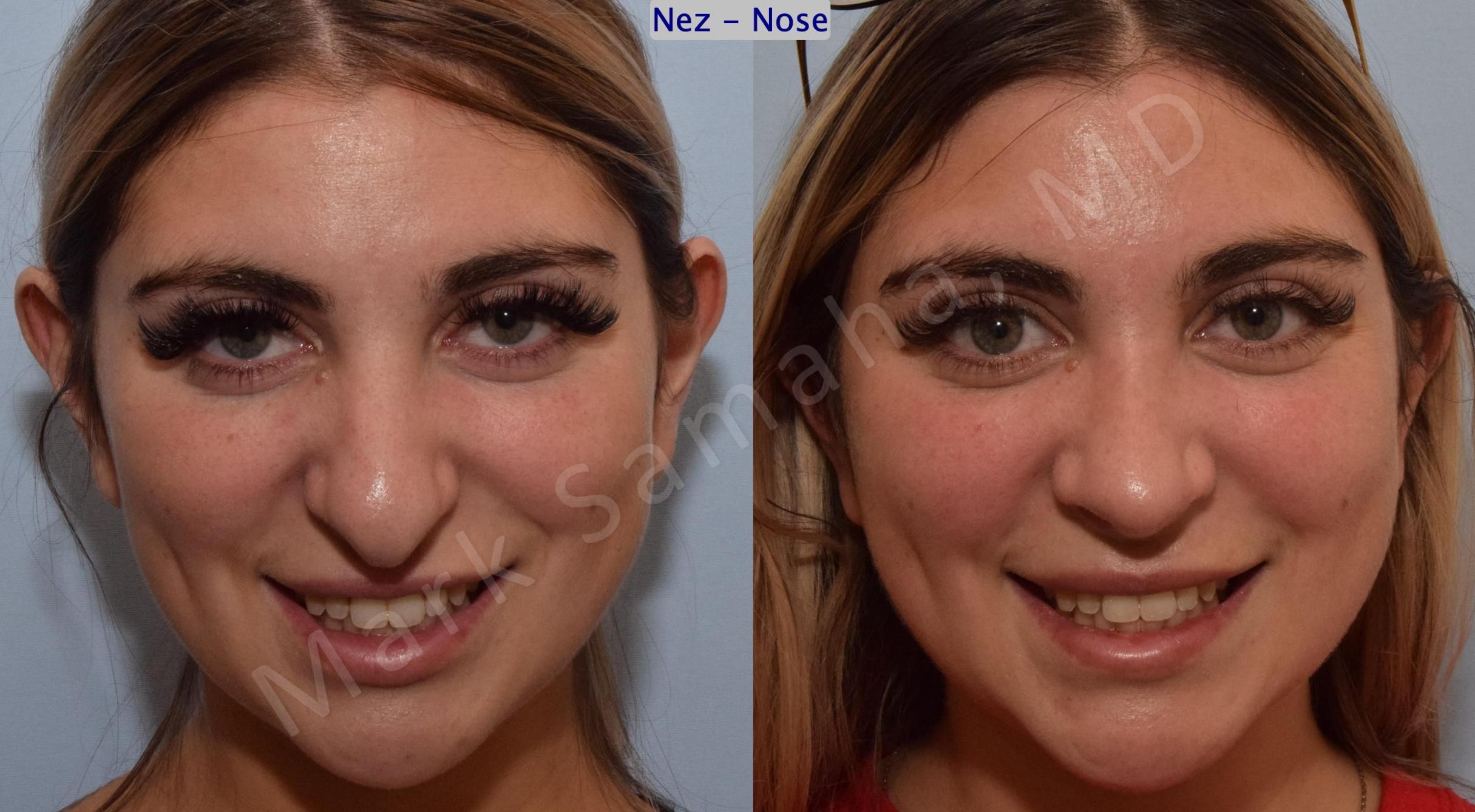 Before & After Rhinoplasty / Rhinoplastie Case 190 Front Smile View in Mount Royal, QC