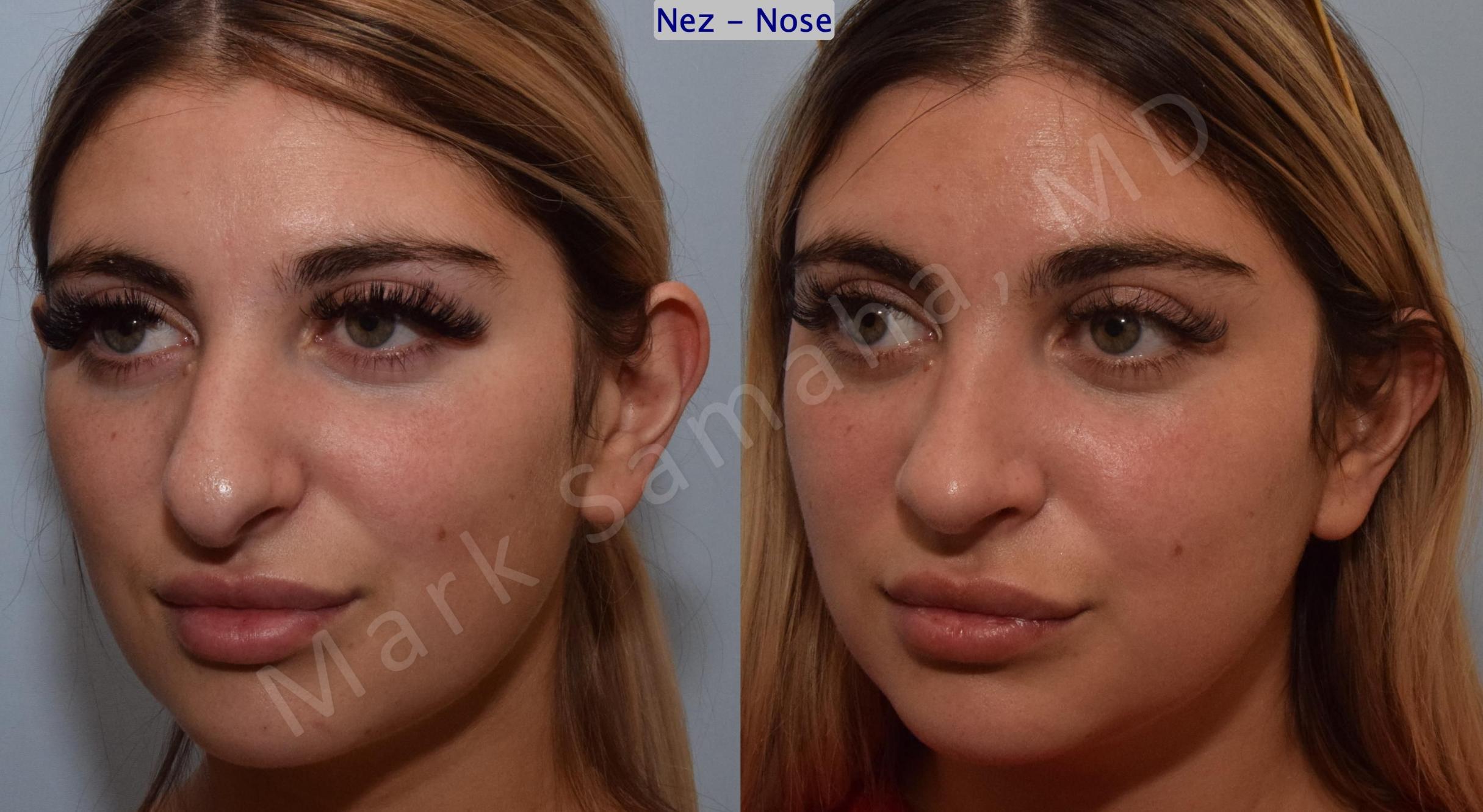 Before & After Rhinoplasty / Rhinoplastie Case 190 Left Oblique View in Mount Royal, QC