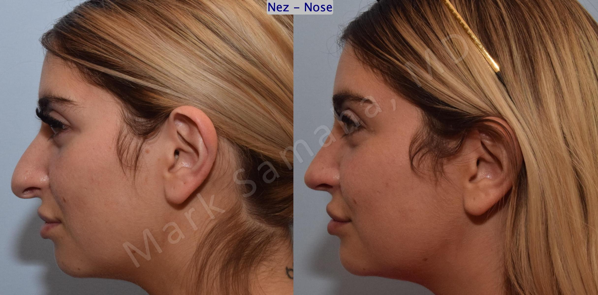 Before & After Rhinoplasty / Rhinoplastie Case 190 Left Side View in Mount Royal, QC