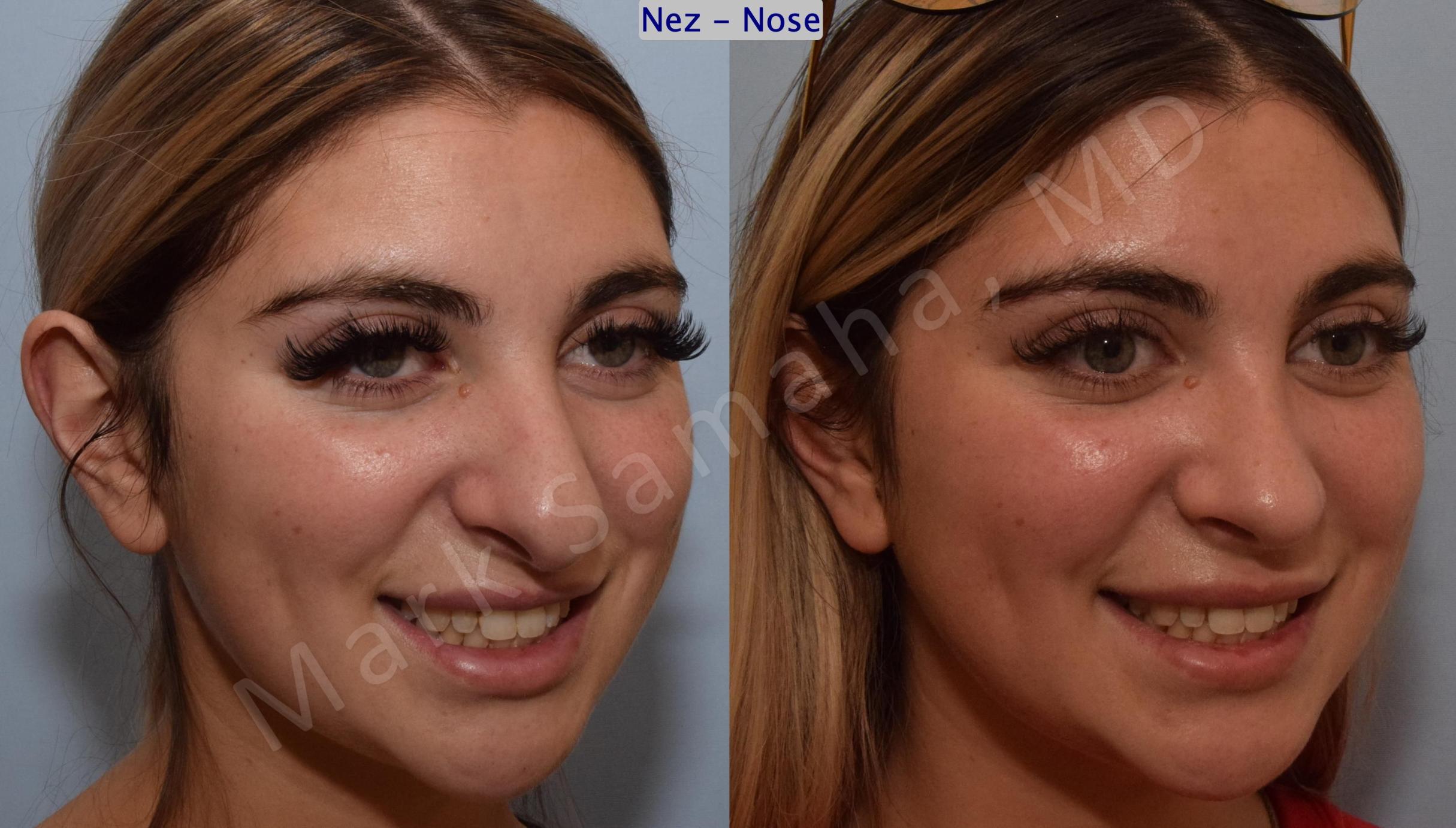 Before & After Rhinoplasty / Rhinoplastie Case 190 Right Oblique Smile View in Mount Royal, QC