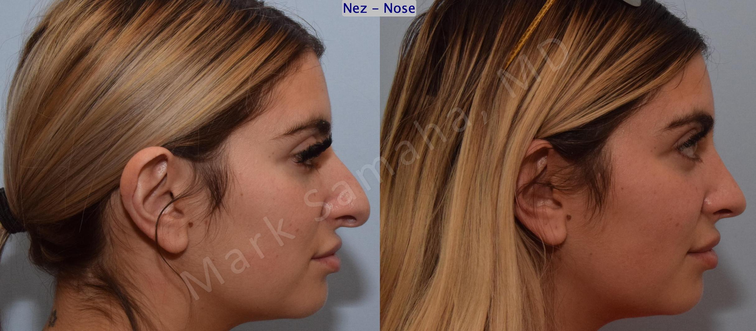 Before & After Rhinoplasty / Rhinoplastie Case 190 Right Side View in Mount Royal, QC