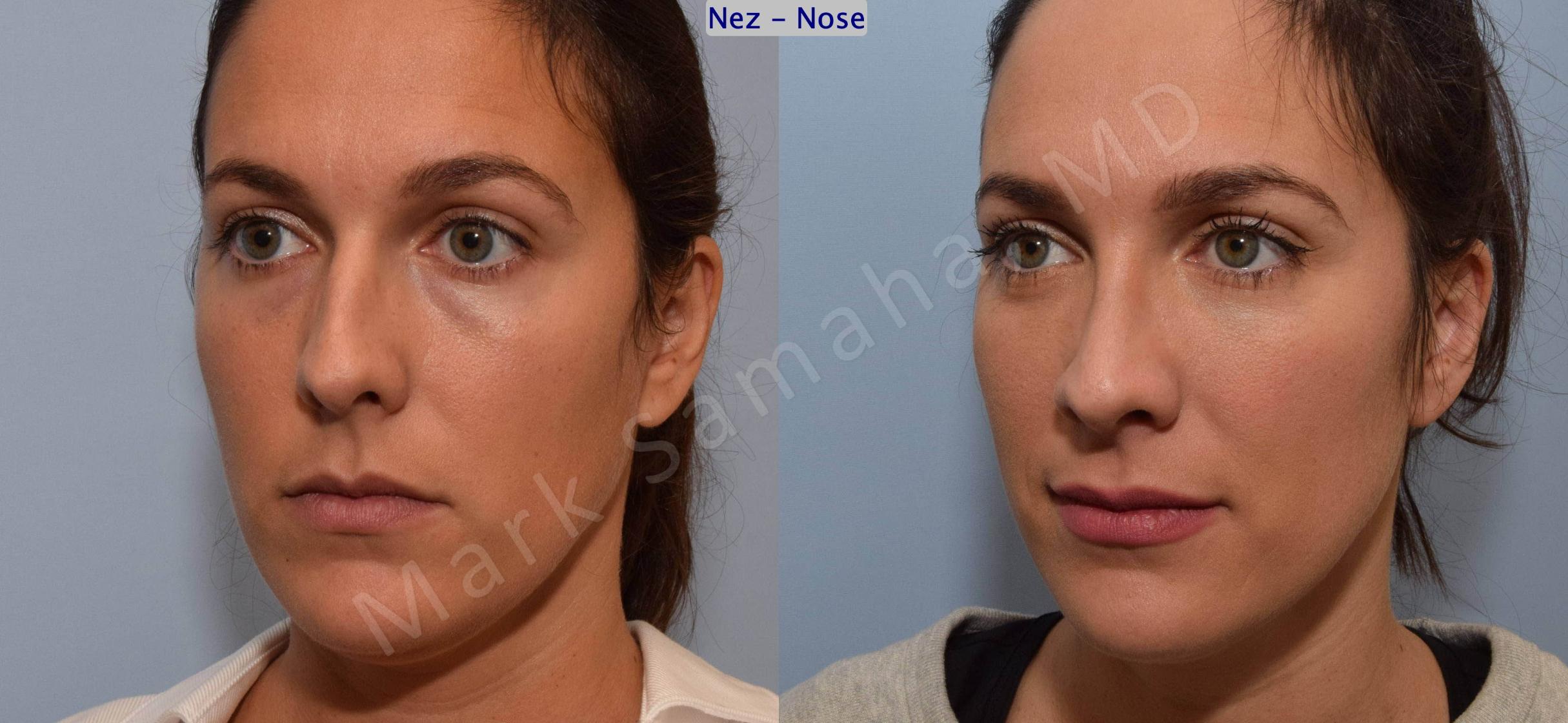 Before & After Rhinoplasty / Rhinoplastie Case 191 Left Oblique View in Mount Royal, QC