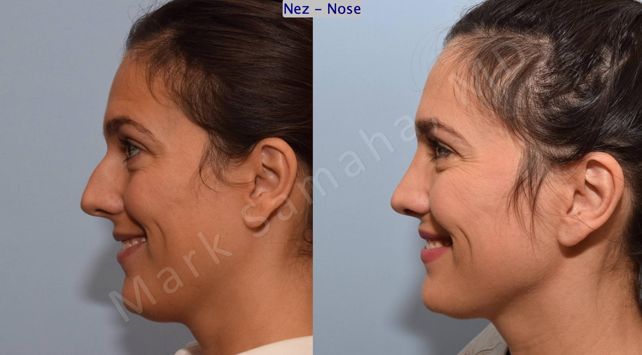 Before & After Rhinoplasty / Rhinoplastie Case 191 Left Side Smile View in Mount Royal, QC