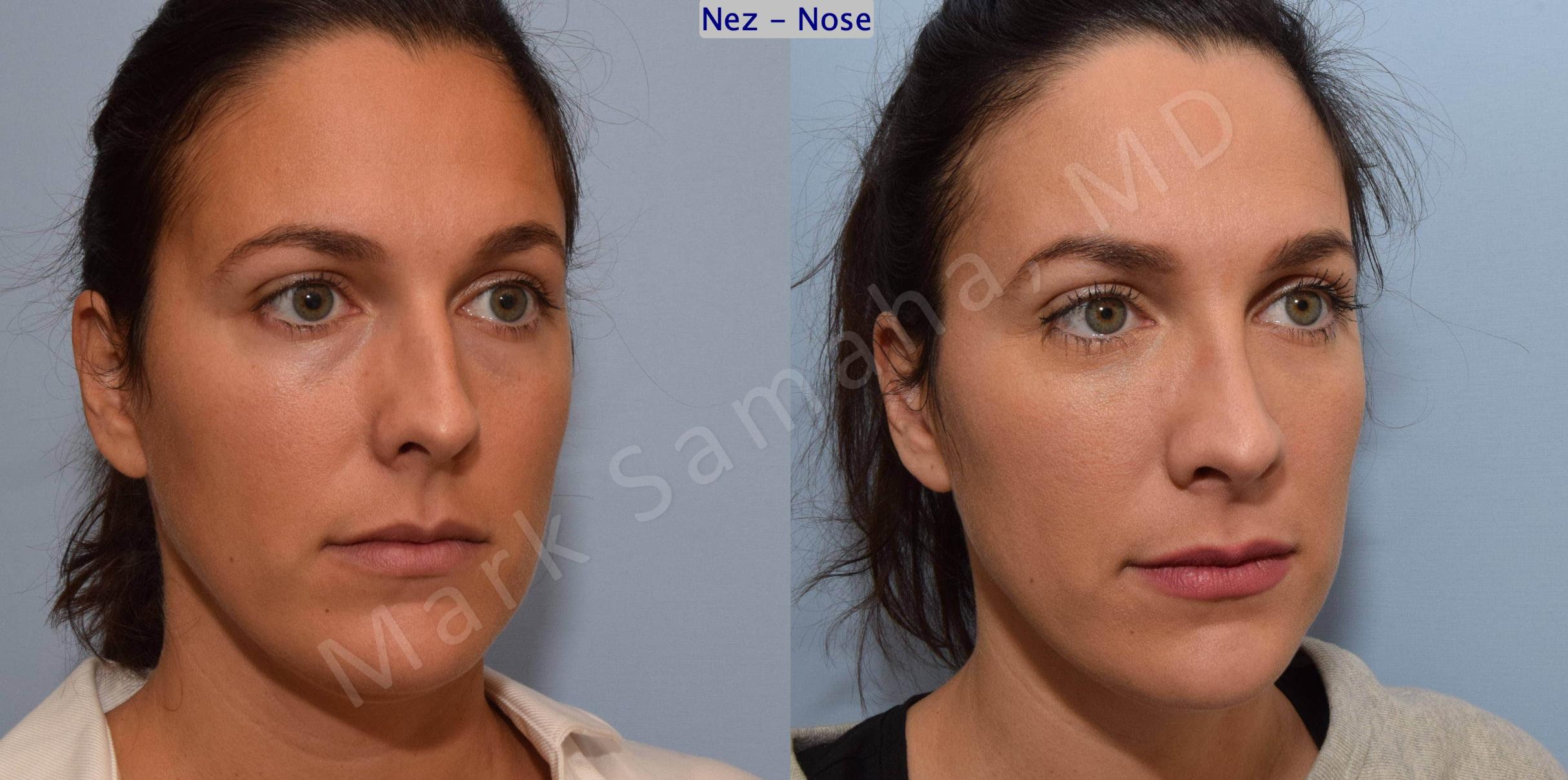 Before & After Rhinoplasty / Rhinoplastie Case 191 Right Oblique View in Mount Royal, QC
