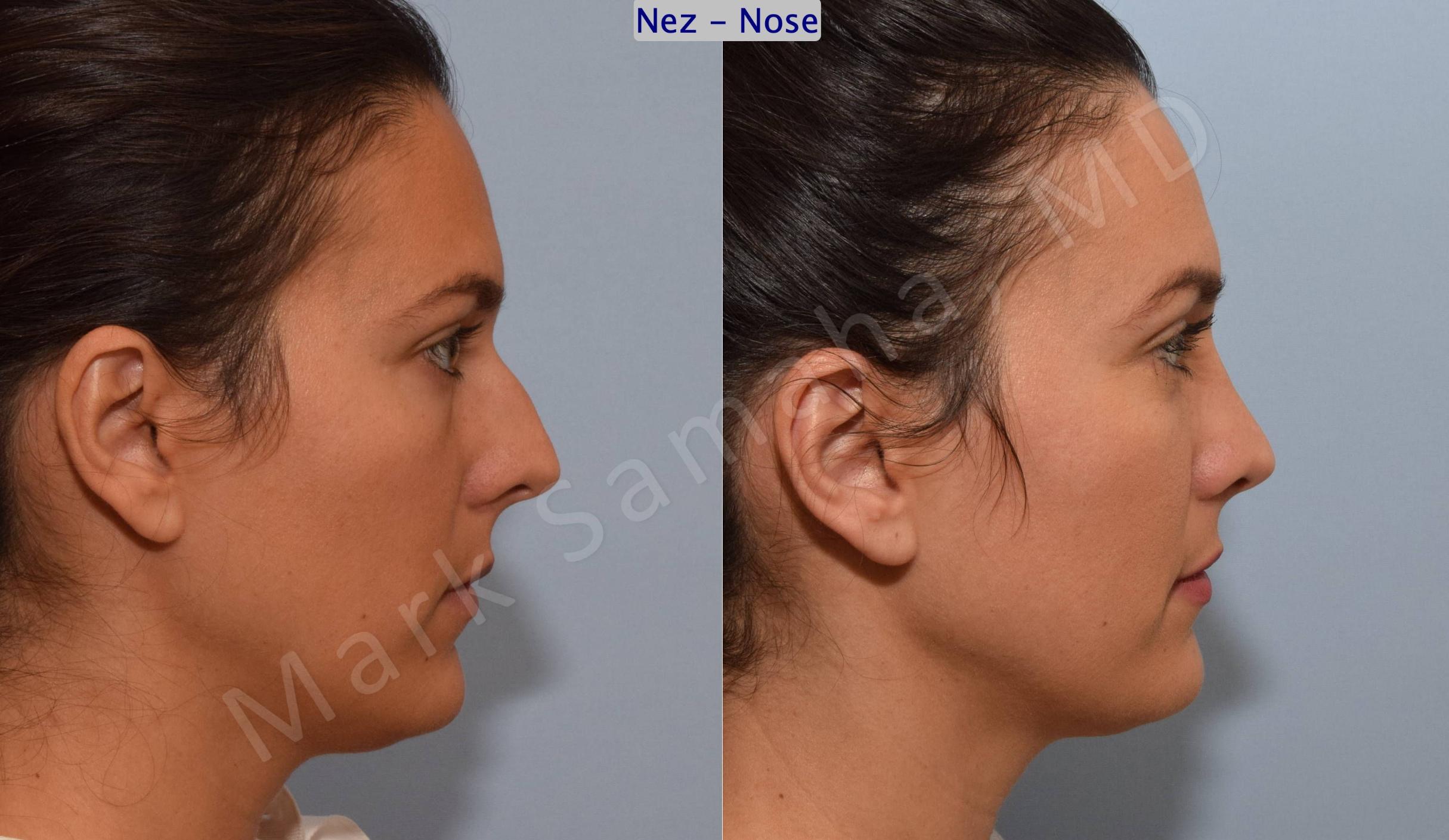 Before & After Rhinoplasty / Rhinoplastie Case 191 Right Side View in Mount Royal, QC