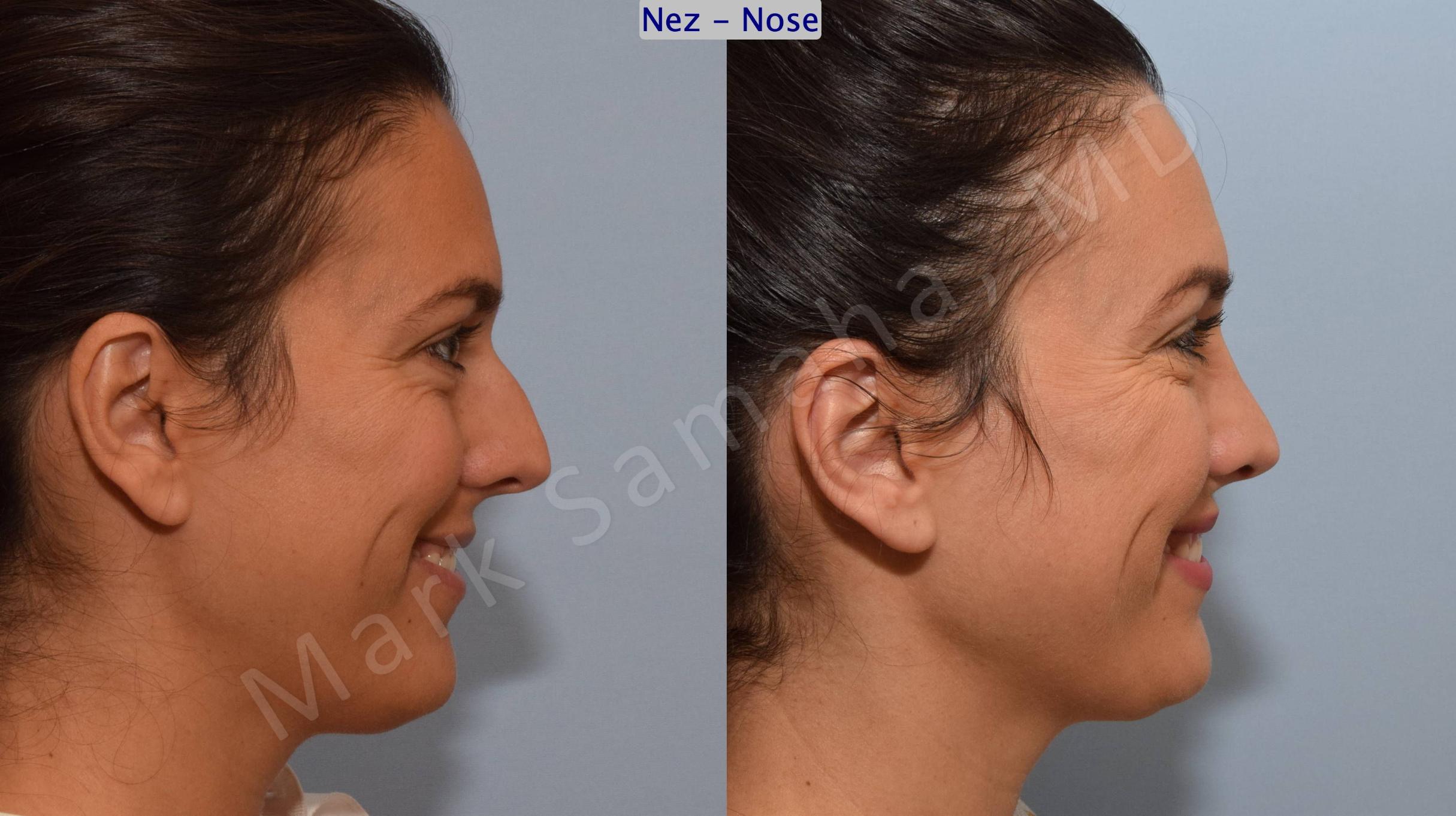 Before & After Rhinoplasty / Rhinoplastie Case 191 Right Side Smile  View in Mount Royal, QC