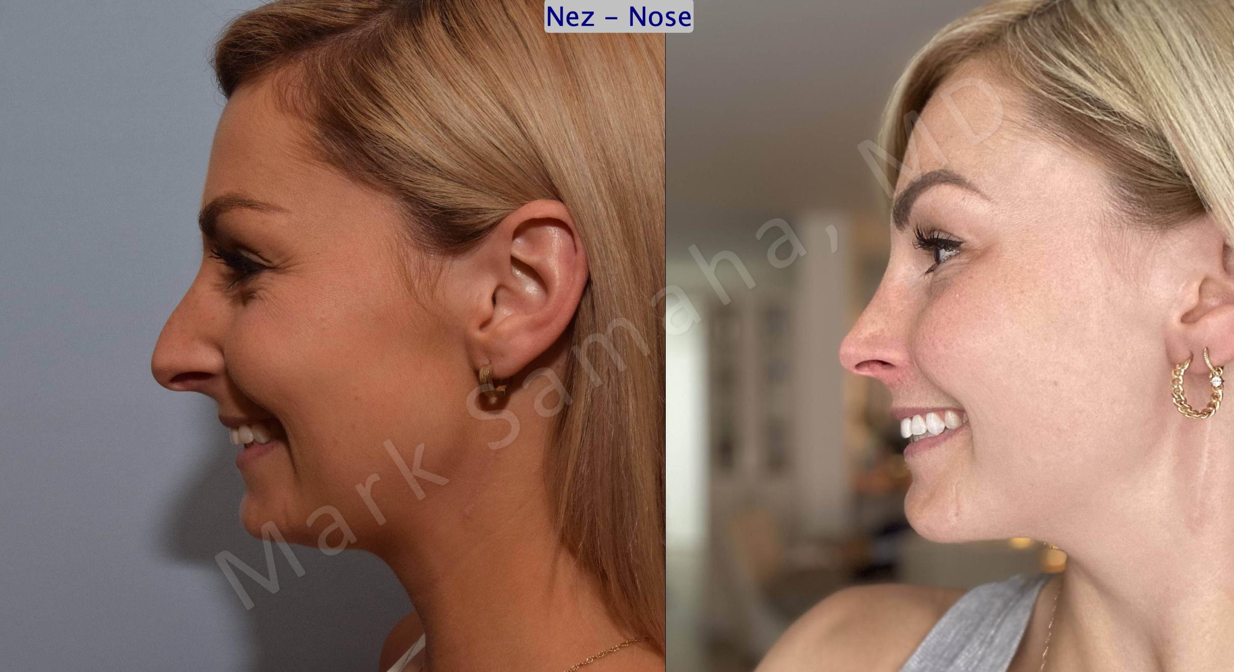 Before & After Rhinoplasty / Rhinoplastie Case 192 Left Side Smile View in Mount Royal, QC
