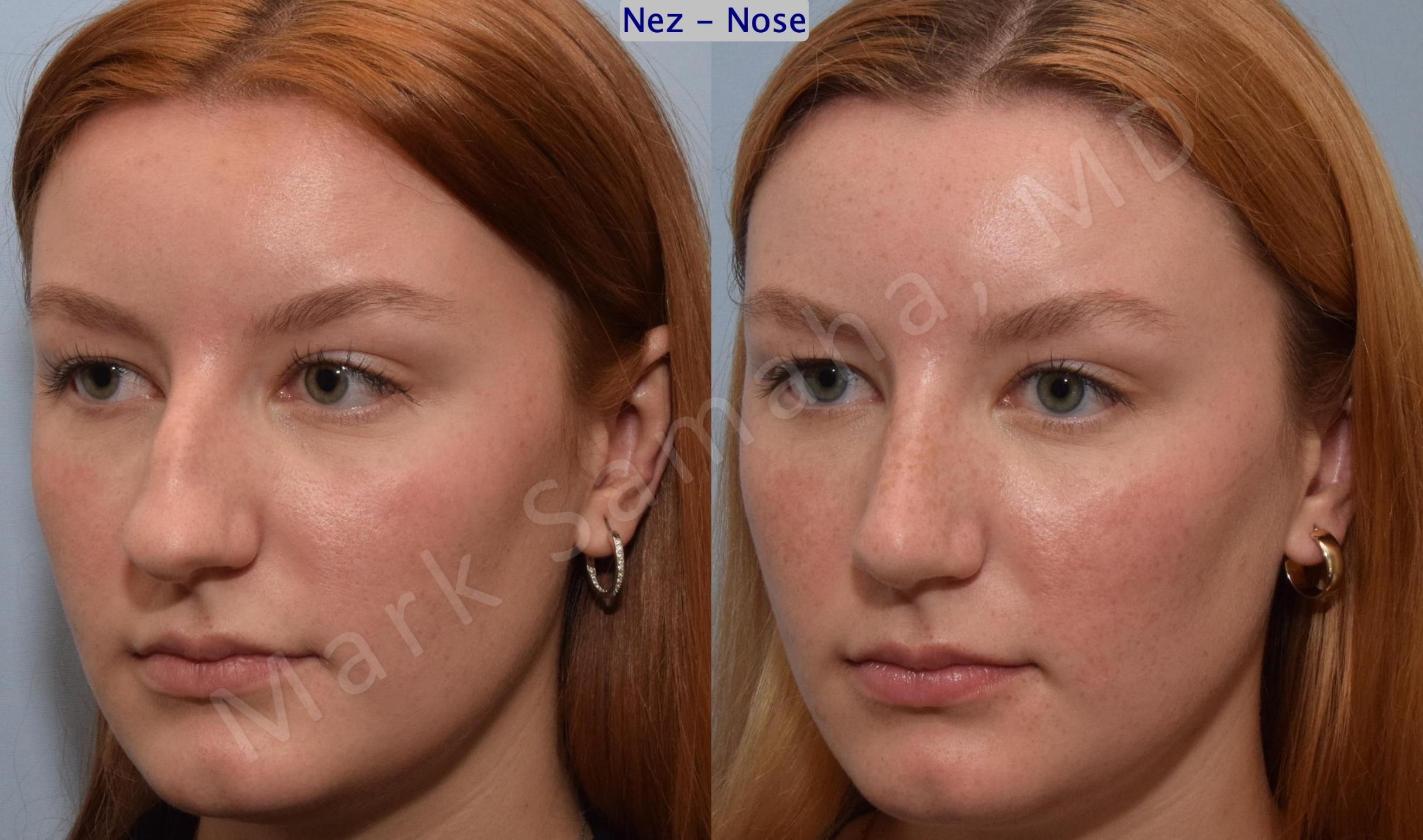 Before & After Rhinoplasty / Rhinoplastie Case 193 Left Oblique View in Mount Royal, QC