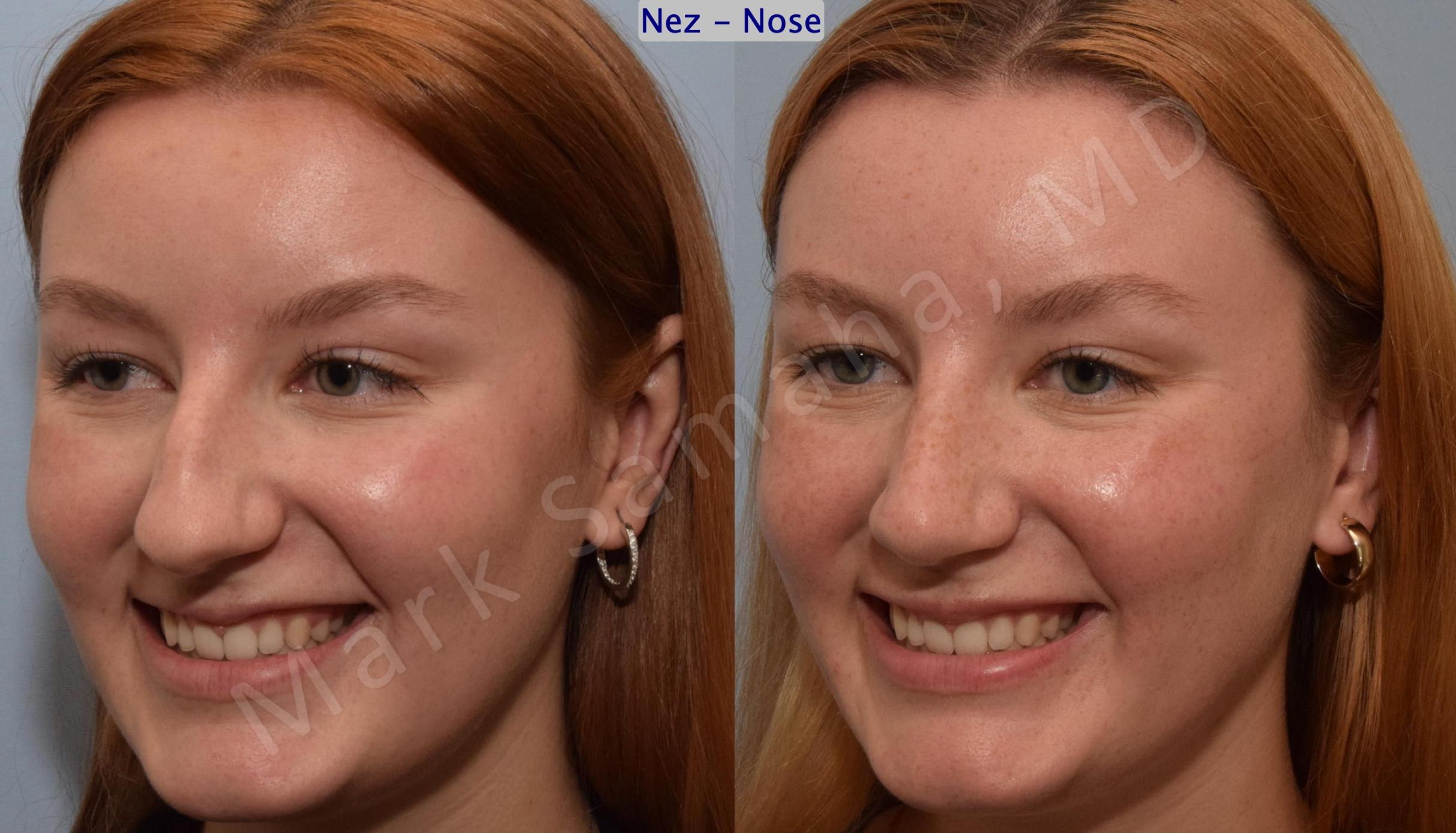 Before & After Rhinoplastie / Rhinoplasty Case 193 Left Oblique Smile View in Mount Royal, QC