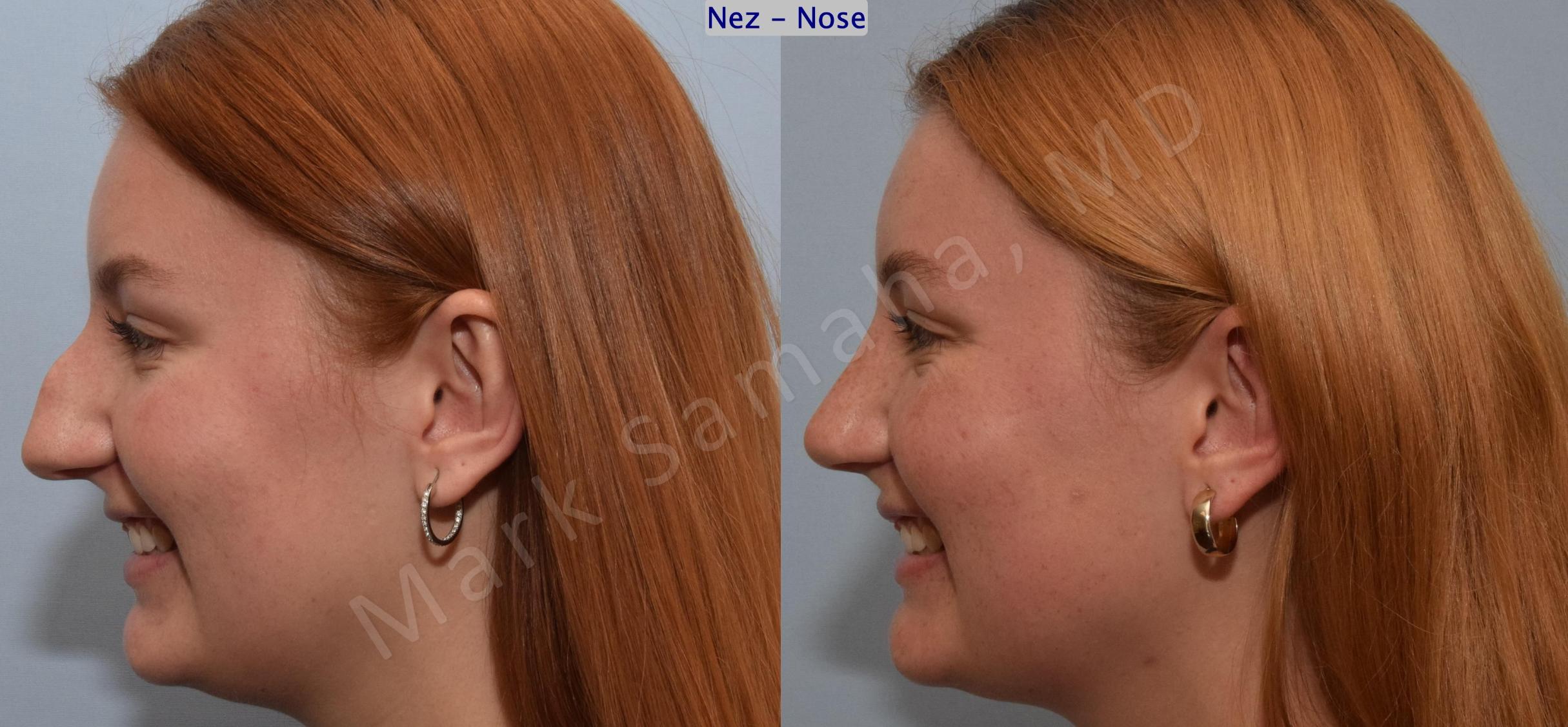 Before & After Rhinoplasty / Rhinoplastie Case 193 Left Side Smile View in Mount Royal, QC